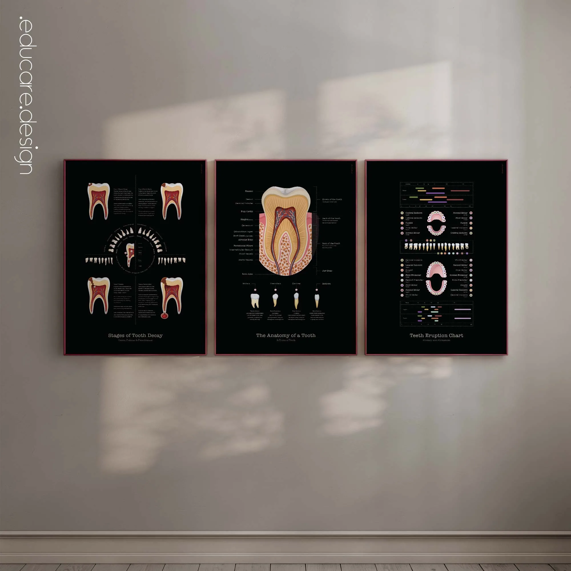 TMJ Disorder anatomy chart for clinics TMJ Disorder anatomy chart for clinics