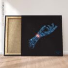 Carpal Tunnel Syndrome