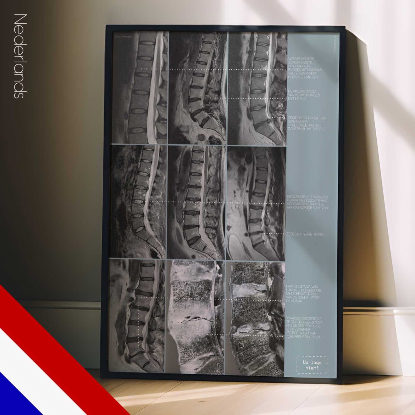 Lumbaal Pathologie