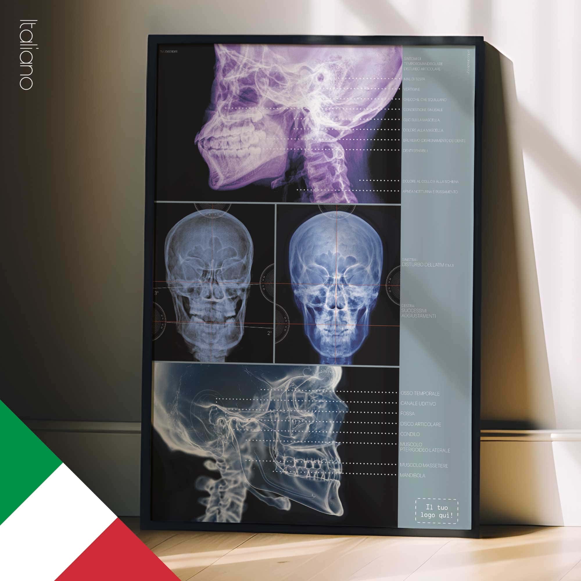 Disturbo Articolazione Temporo-Mandibolare