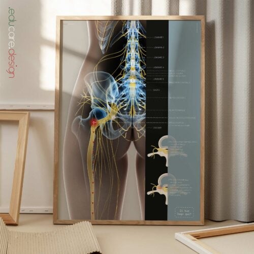 Sciatica e Stenosi