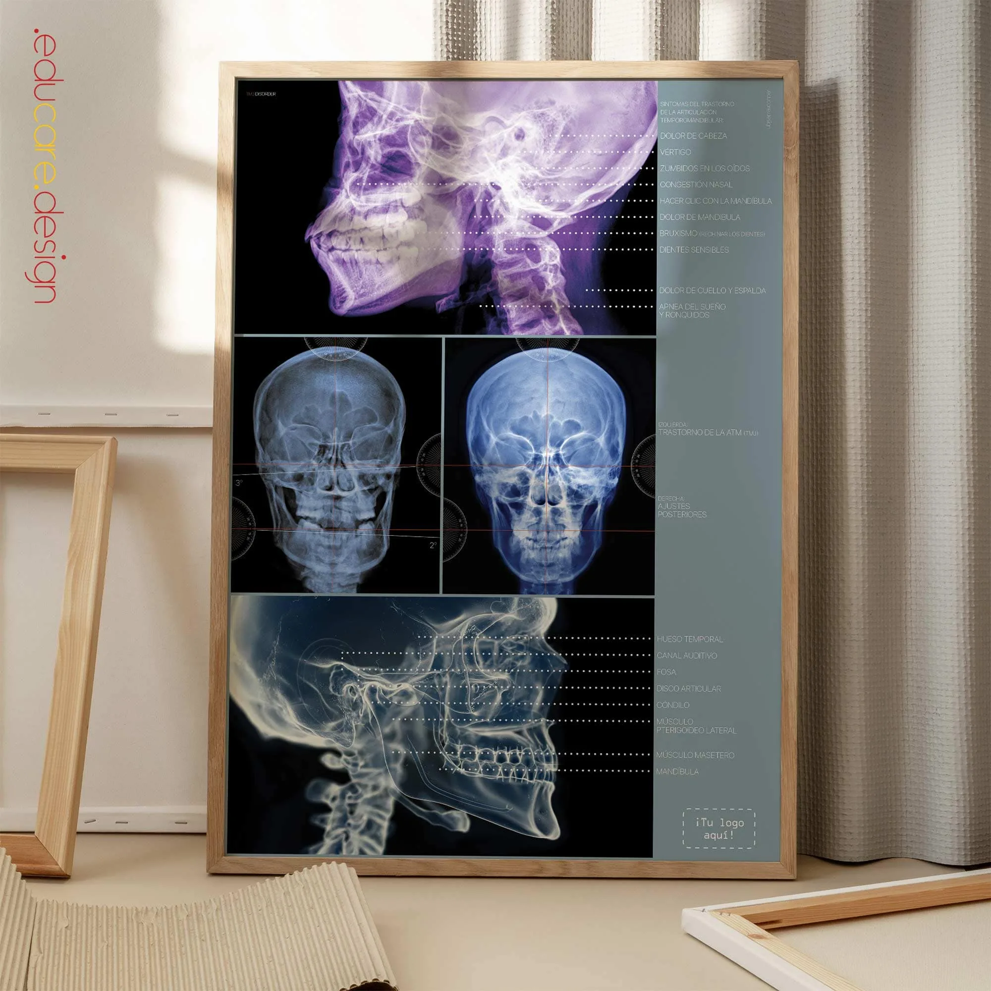 Trastorno de la Articulación Temporomandibular (ATM) lámina anatómica para clínicas y consultas