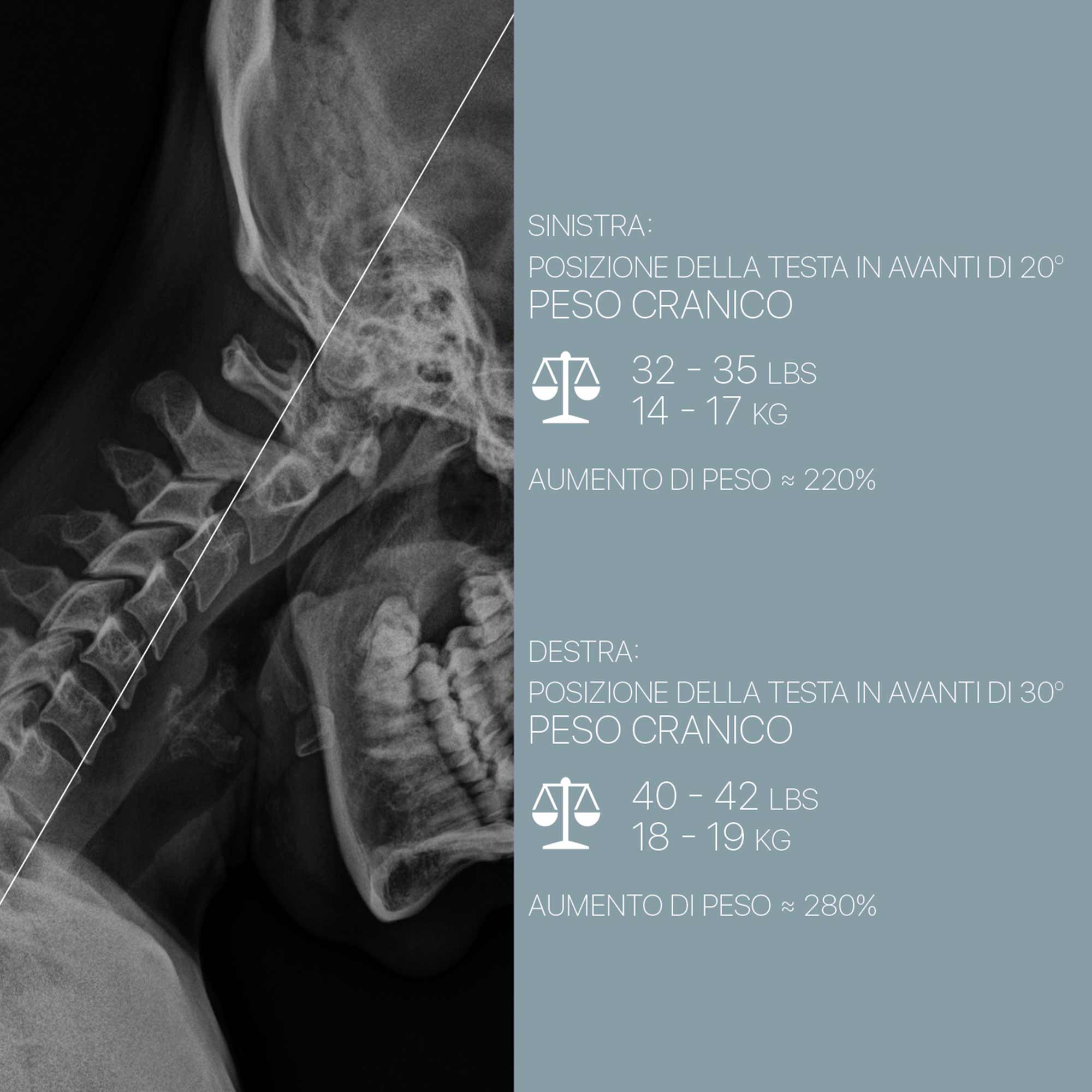The Forward Head Posture