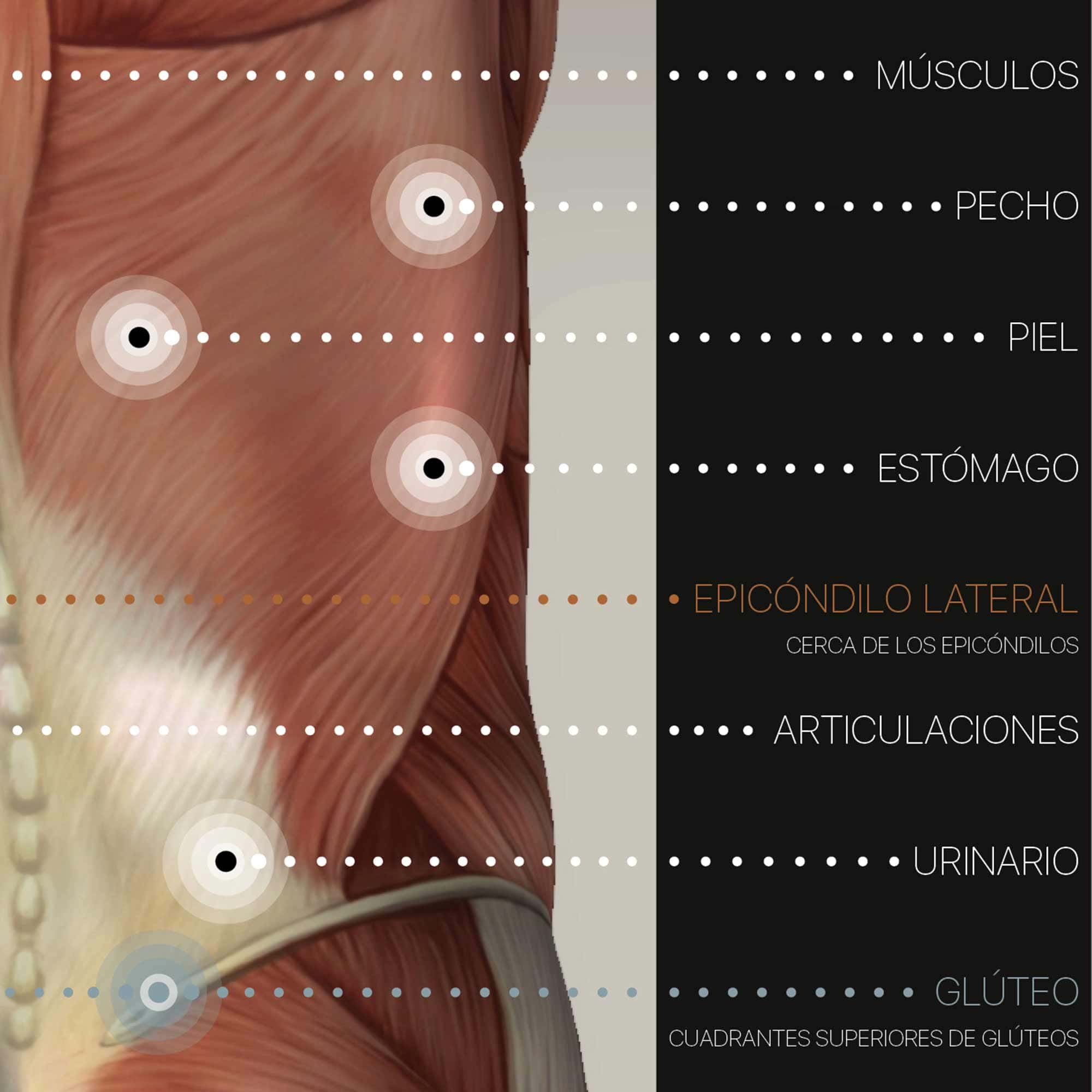 Fibromialgia; Puntos Sensibles y Síntomas