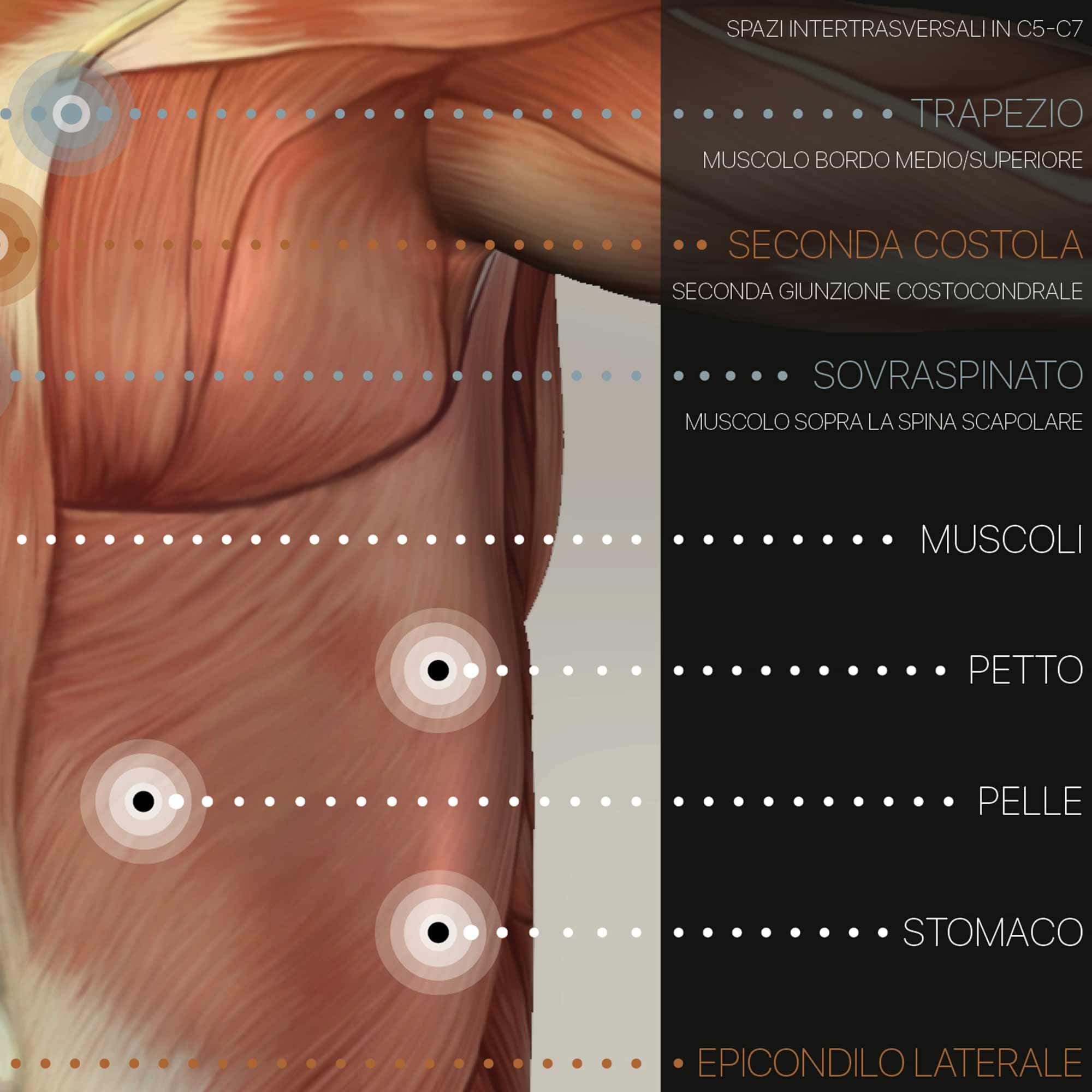 Fibromialgia; Punti teneri e sintomi
