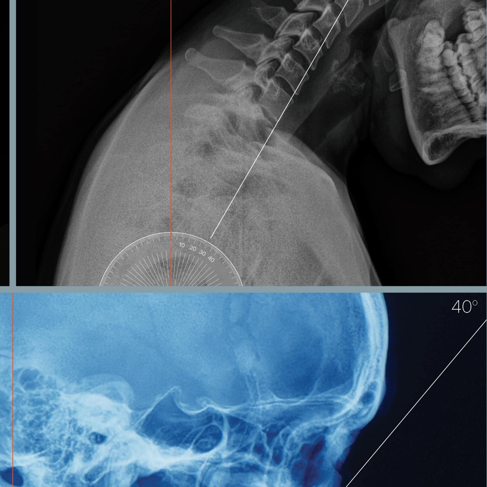 Forward Head Posture and Cranial Weight