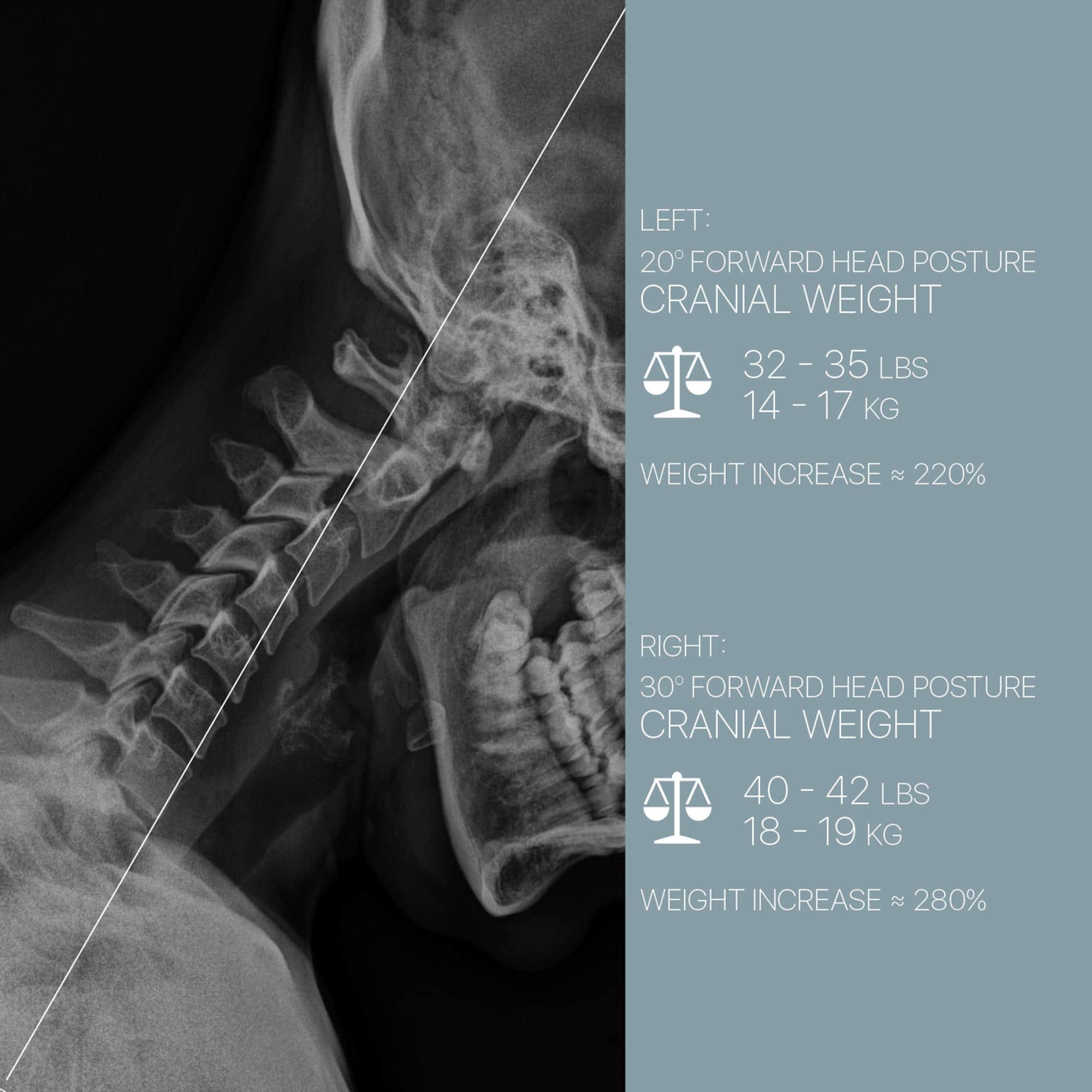 Forward Head Posture and Cranial Weight