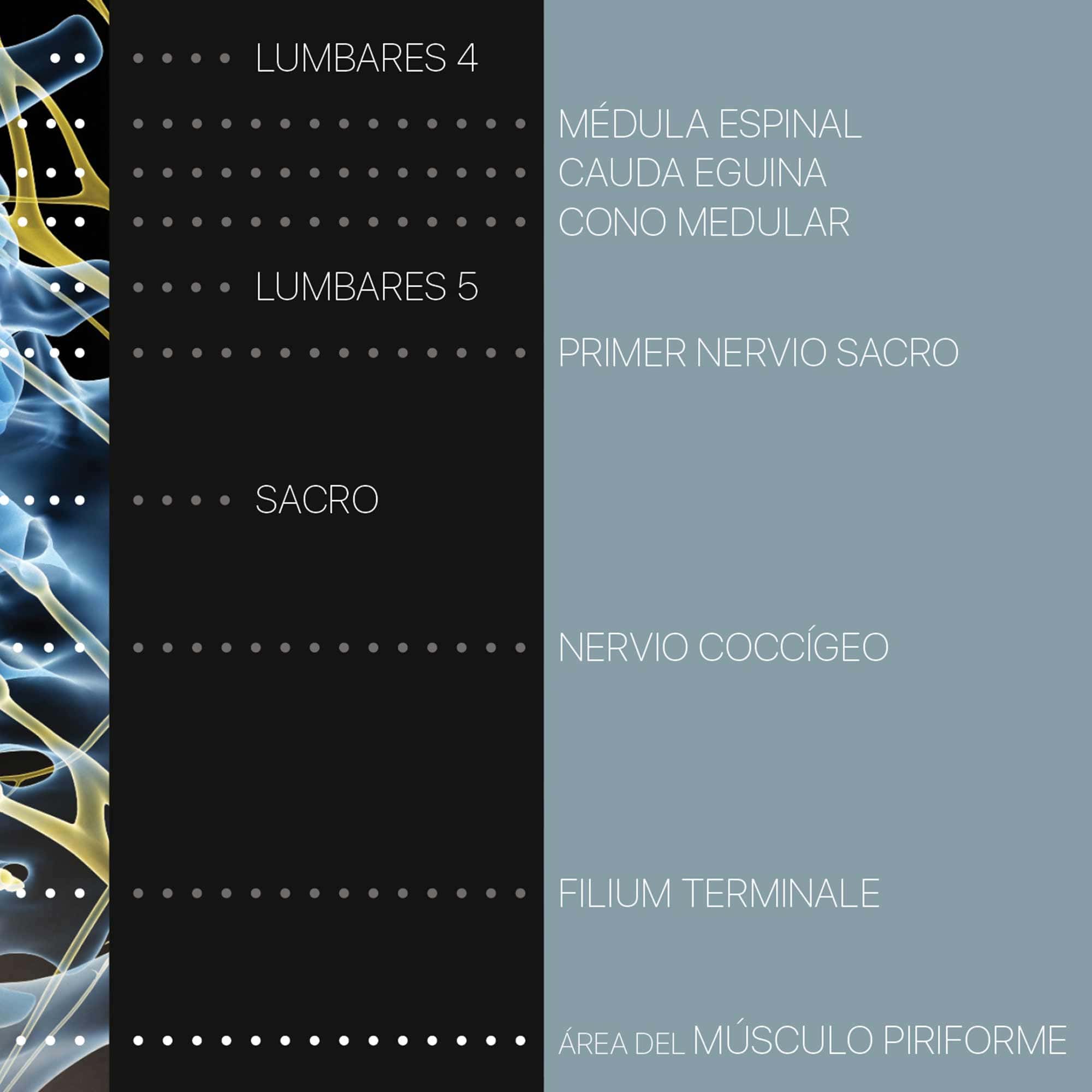 Mechanism of Sciatica