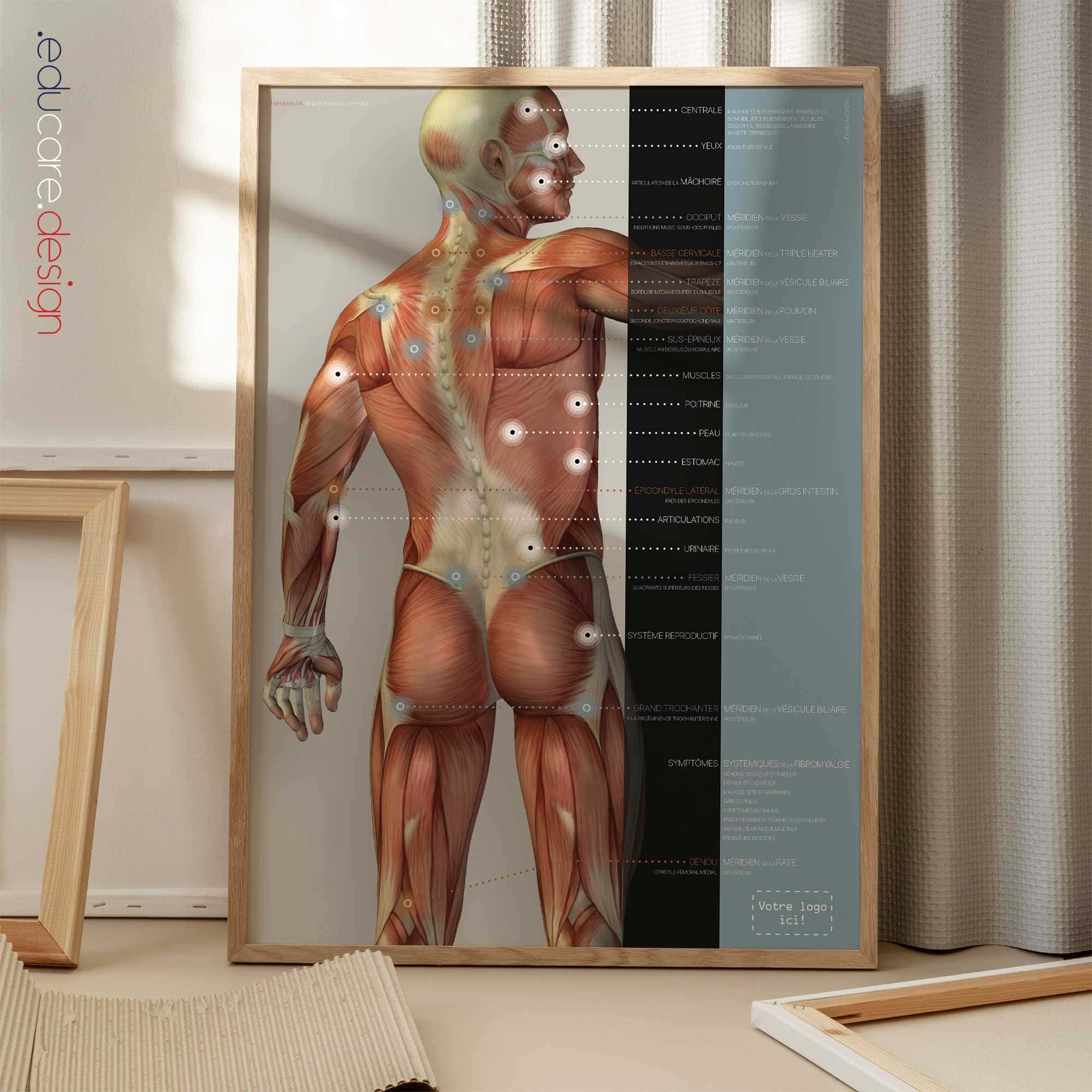 Fibromyalgie ; Points Sensibles et Symptômes planche anatomique pour cabinets et cliniques