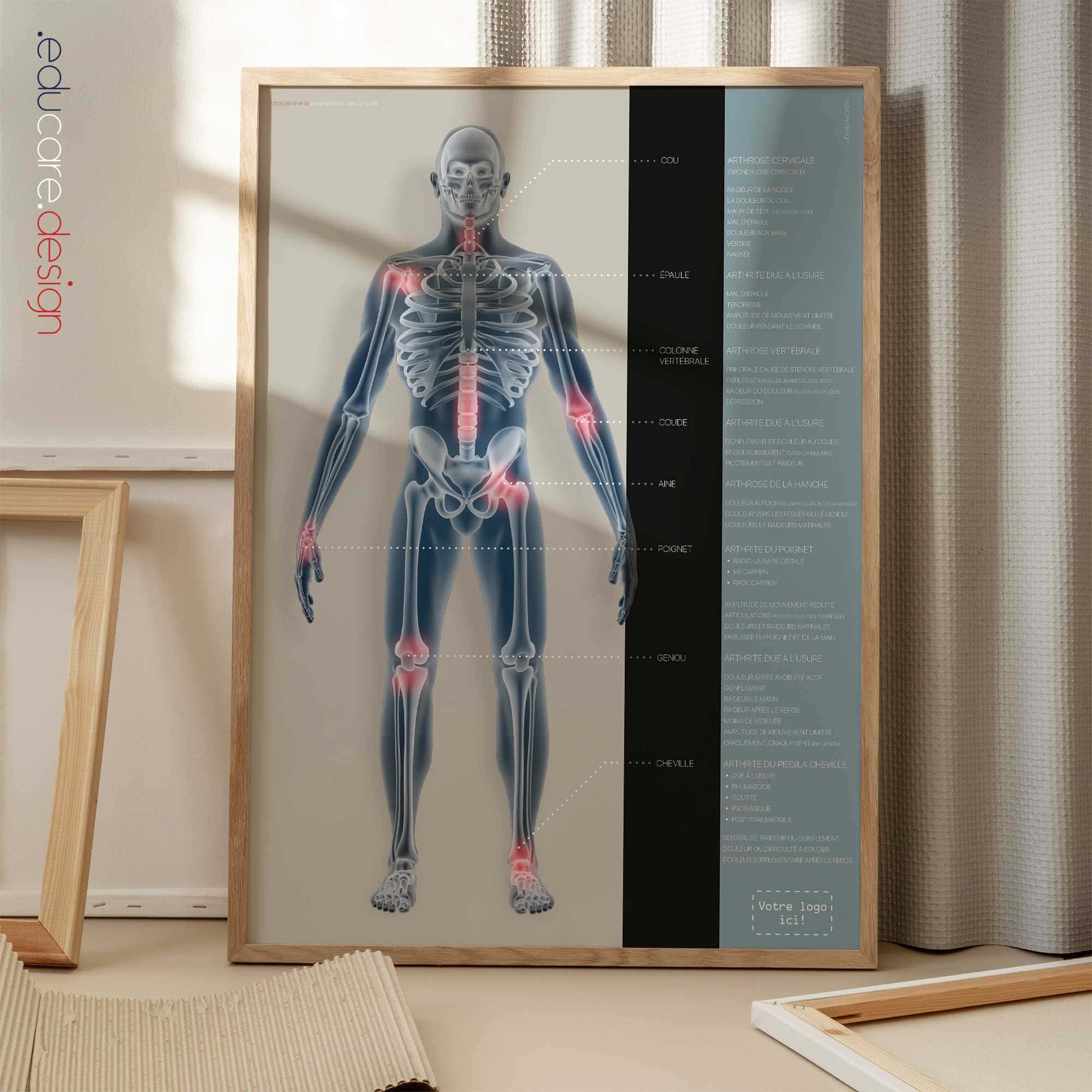 Arthrose planche anatomique pour cabinets et cliniques