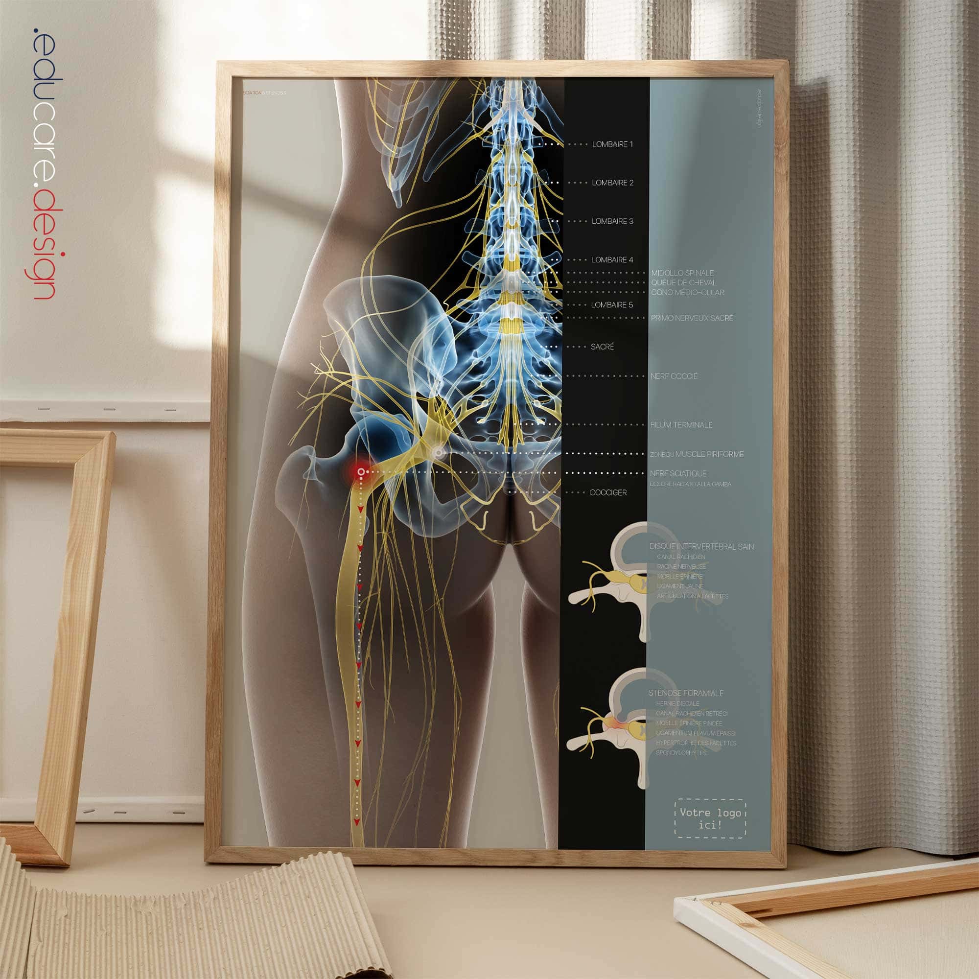 Sciatique et Sténose planche anatomique pour cabinets et cliniques