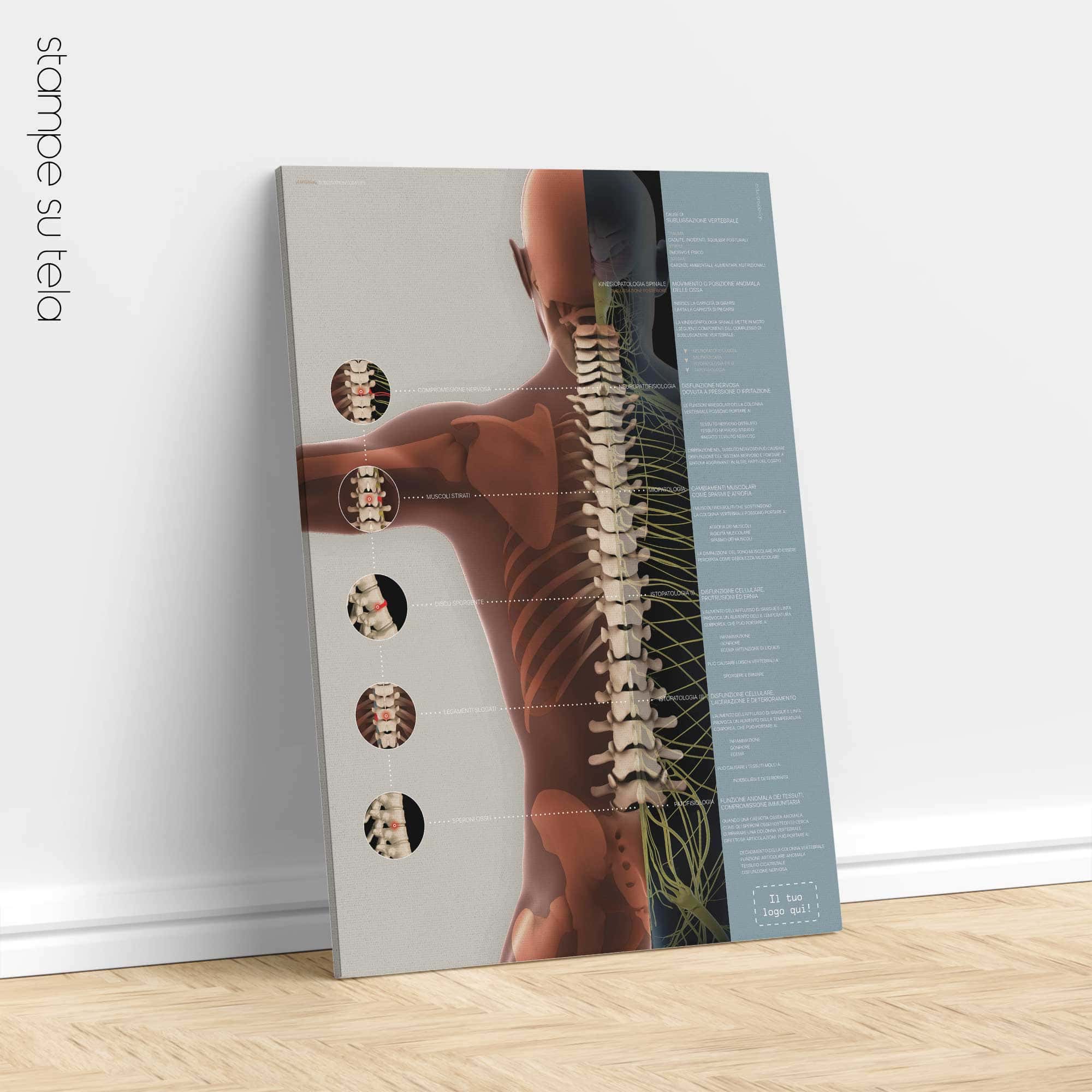 Complesso di Sublussazione Vertebrale