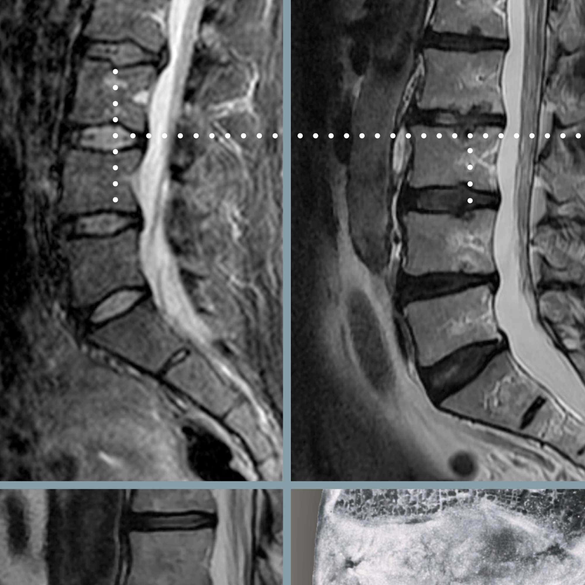 Lumbar Pathologies dutch lumbar pathology zoom 02