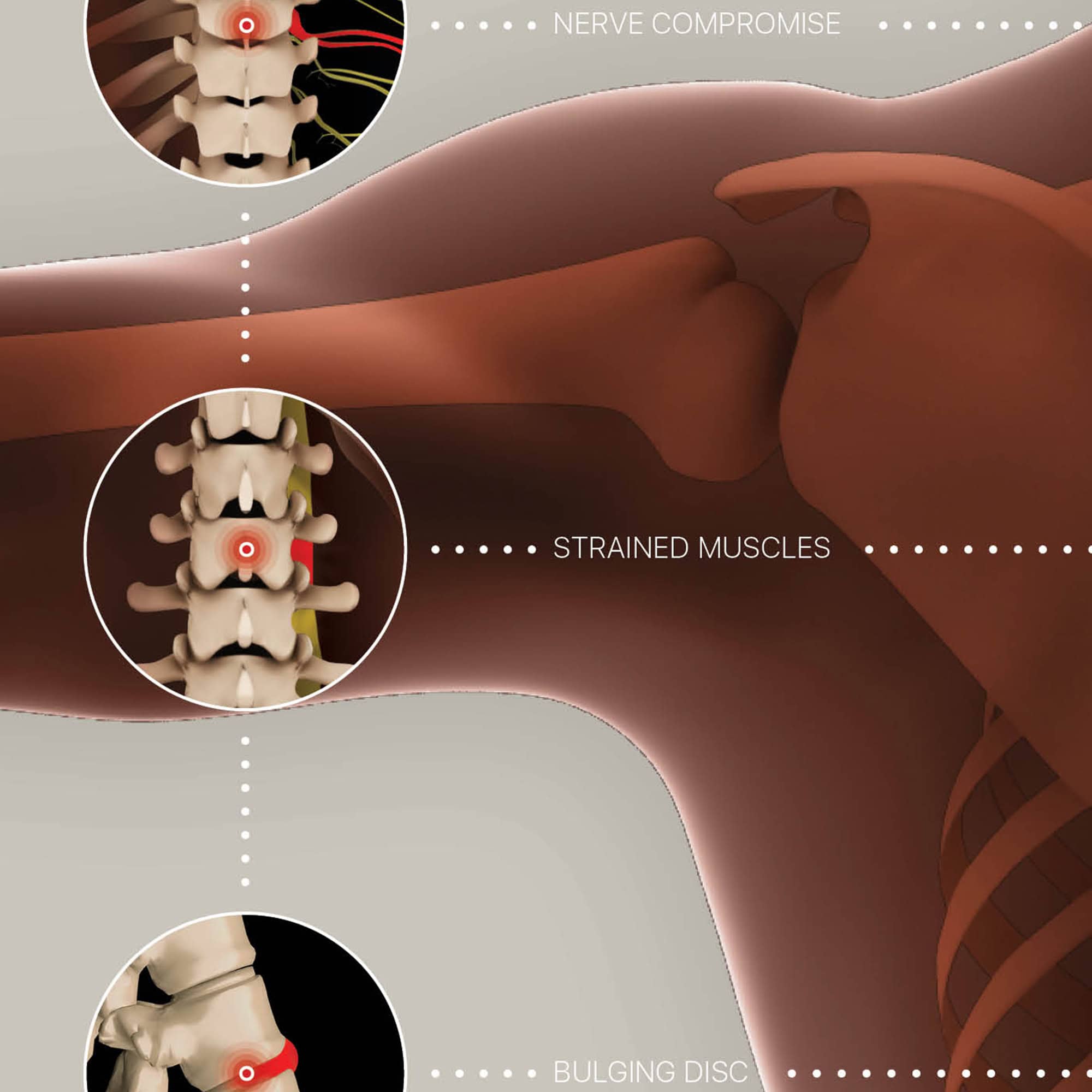 Vertebral Subluxation Complex