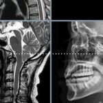 Pathologie Cervicale