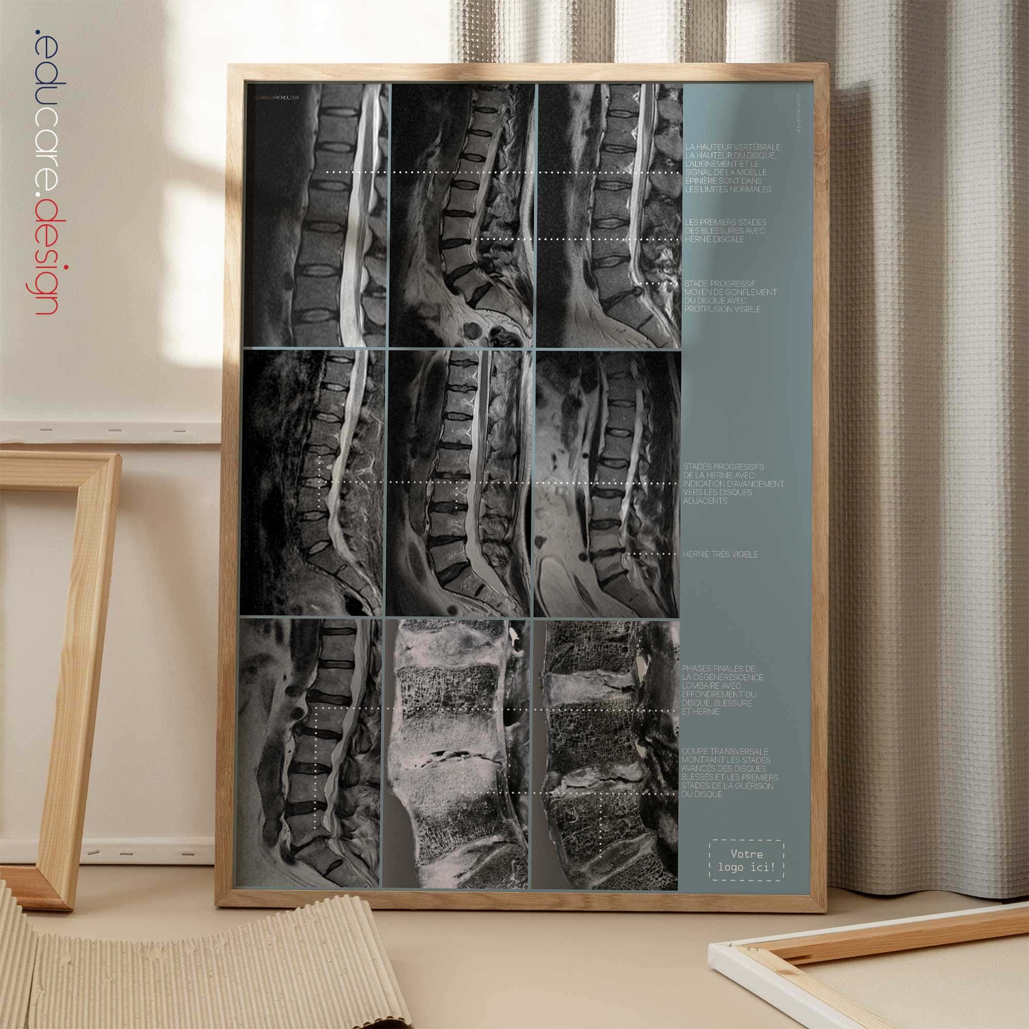 Pathologie Lombaire planche anatomique pour cabinets et cliniques Pathologie Lombaire planche anatomique pour cabinets et cliniques