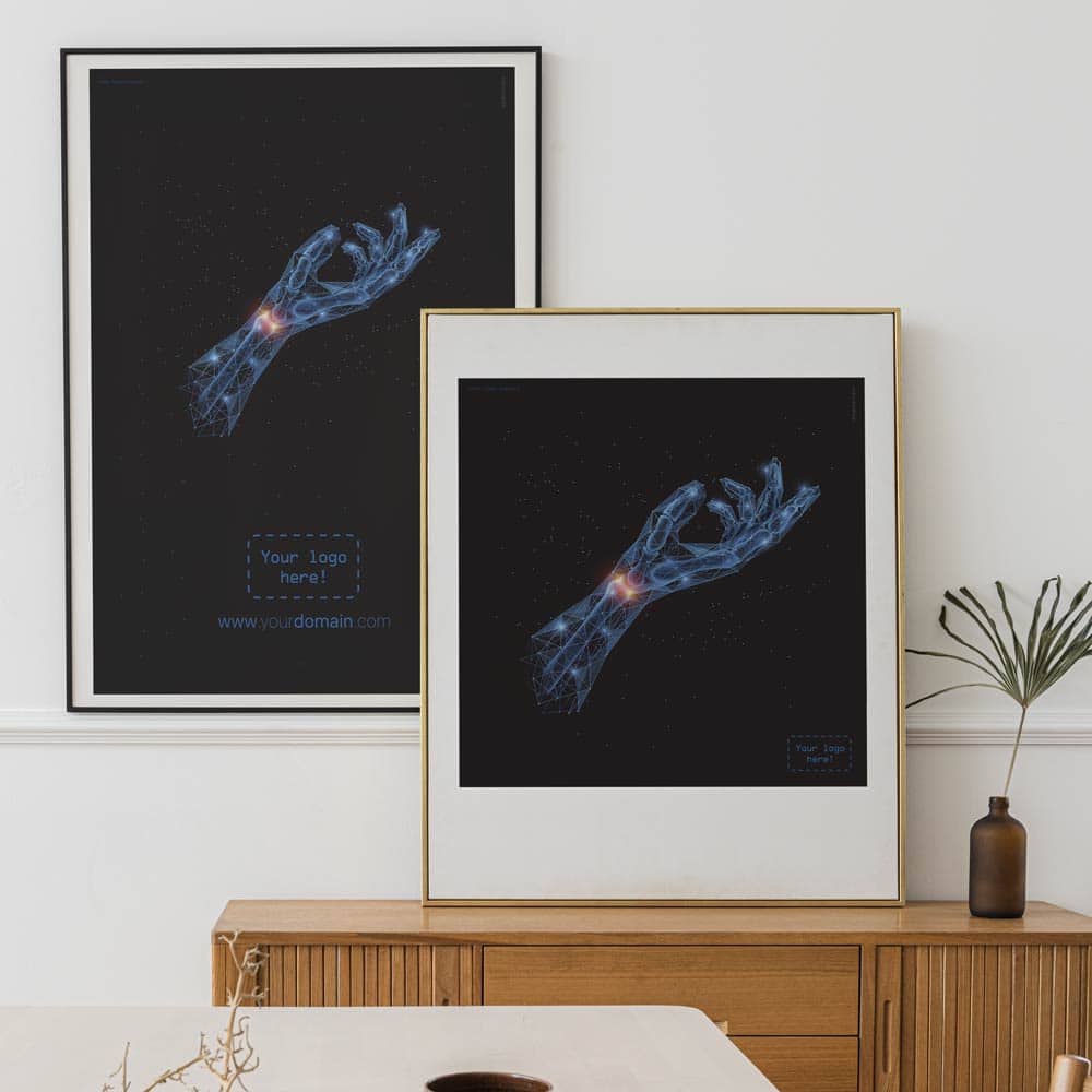 Syndrome du Canal Carpien