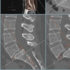 Spondylolisthesis – educare.design Spondylolisthesis