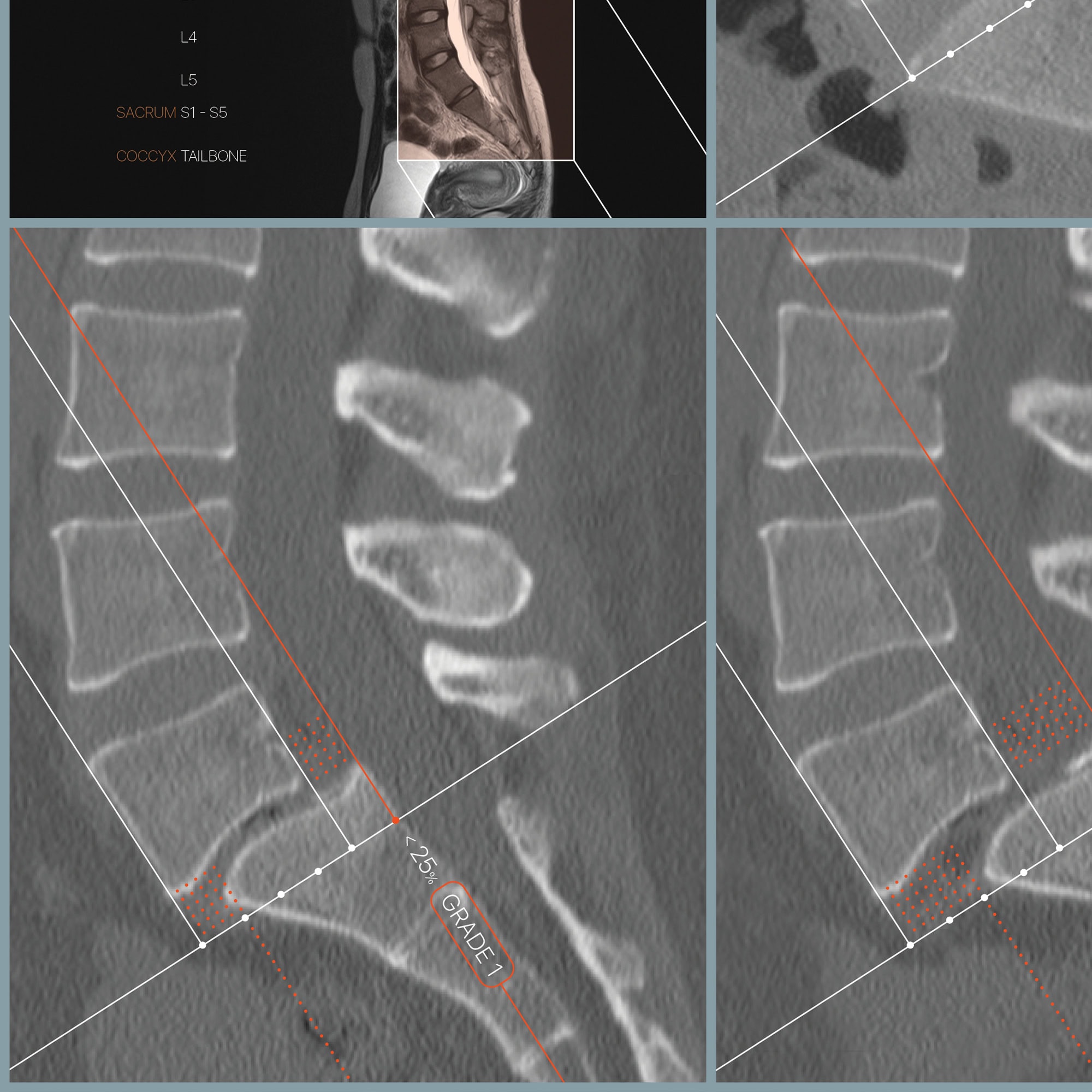 Spondylolisthesis