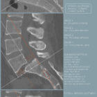 Spondylolisthesis – educare.design Spondylolisthesis