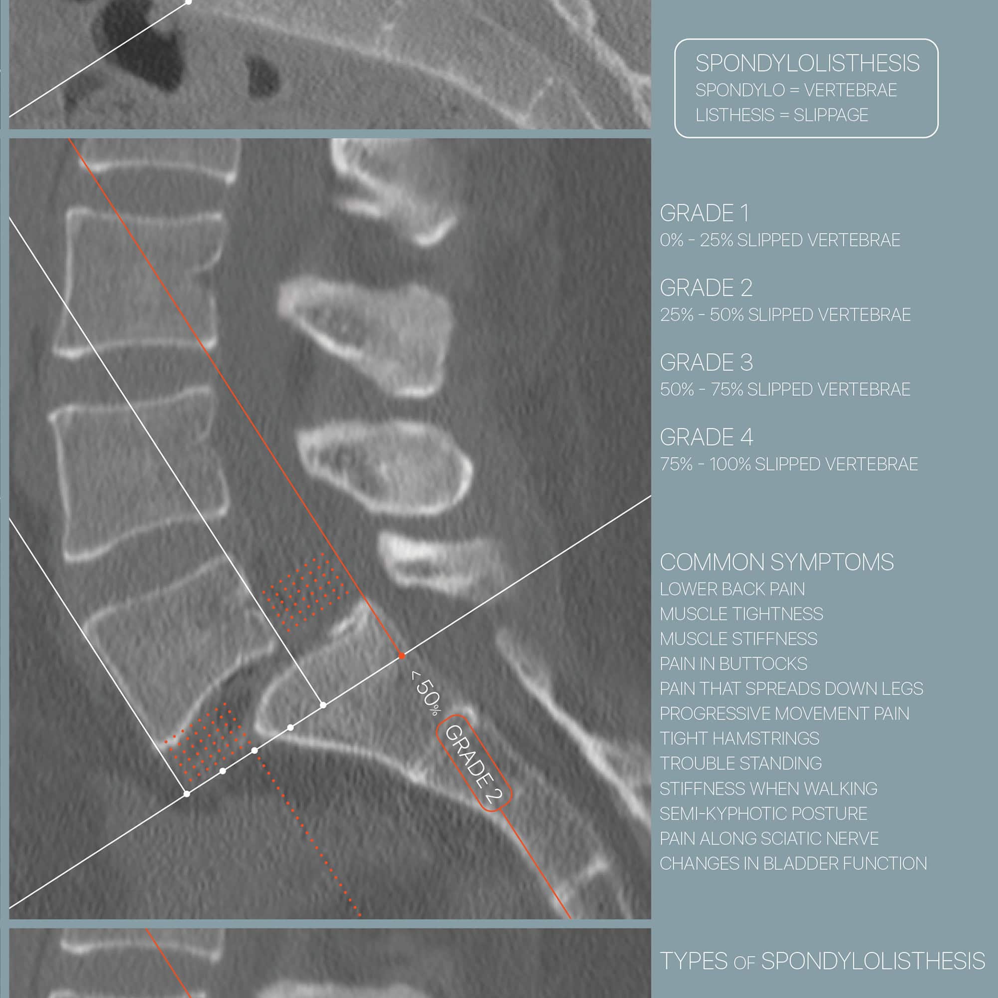 Spondylolisthesis