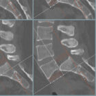 Spondylolisthesis – educare.design Spondylolisthesis