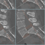 Spondylolisthesis