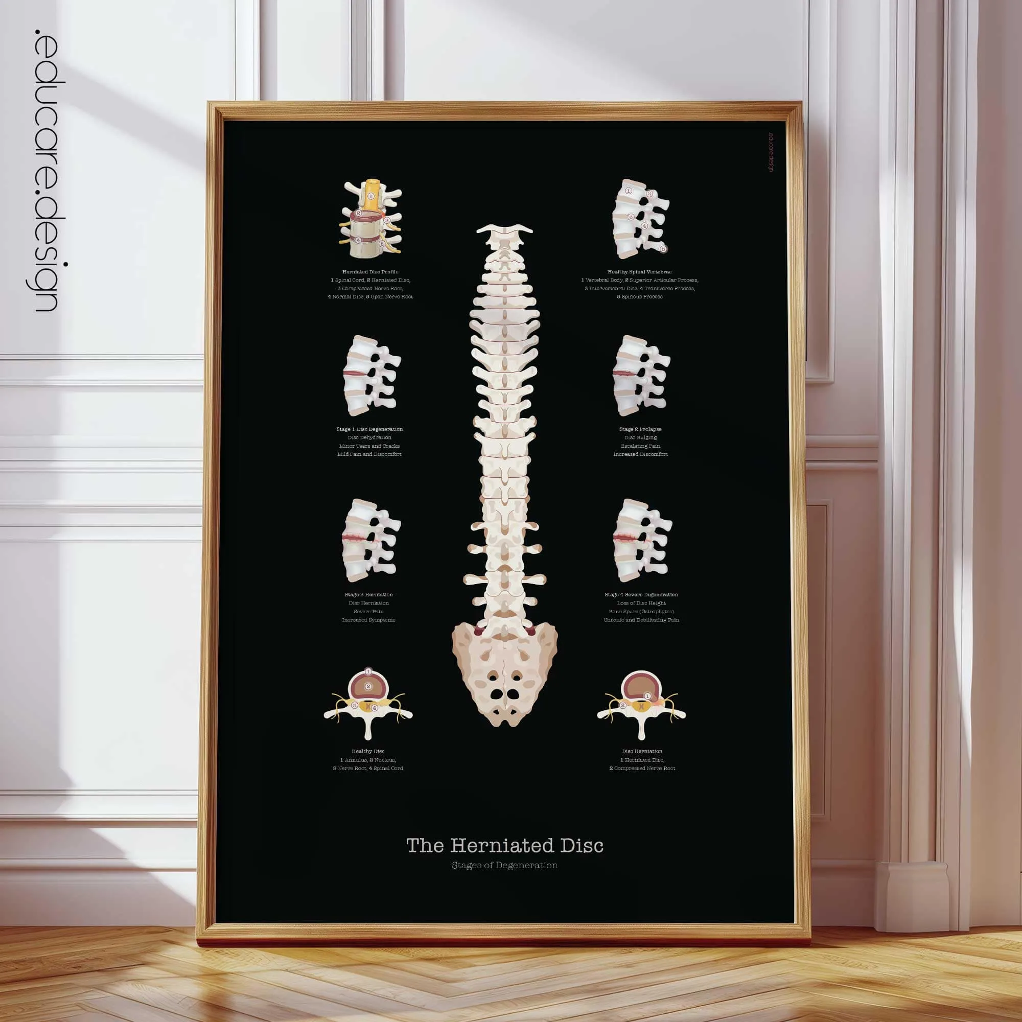 TMJ Disorder anatomy chart for clinics TMJ Disorder anatomy chart for clinics