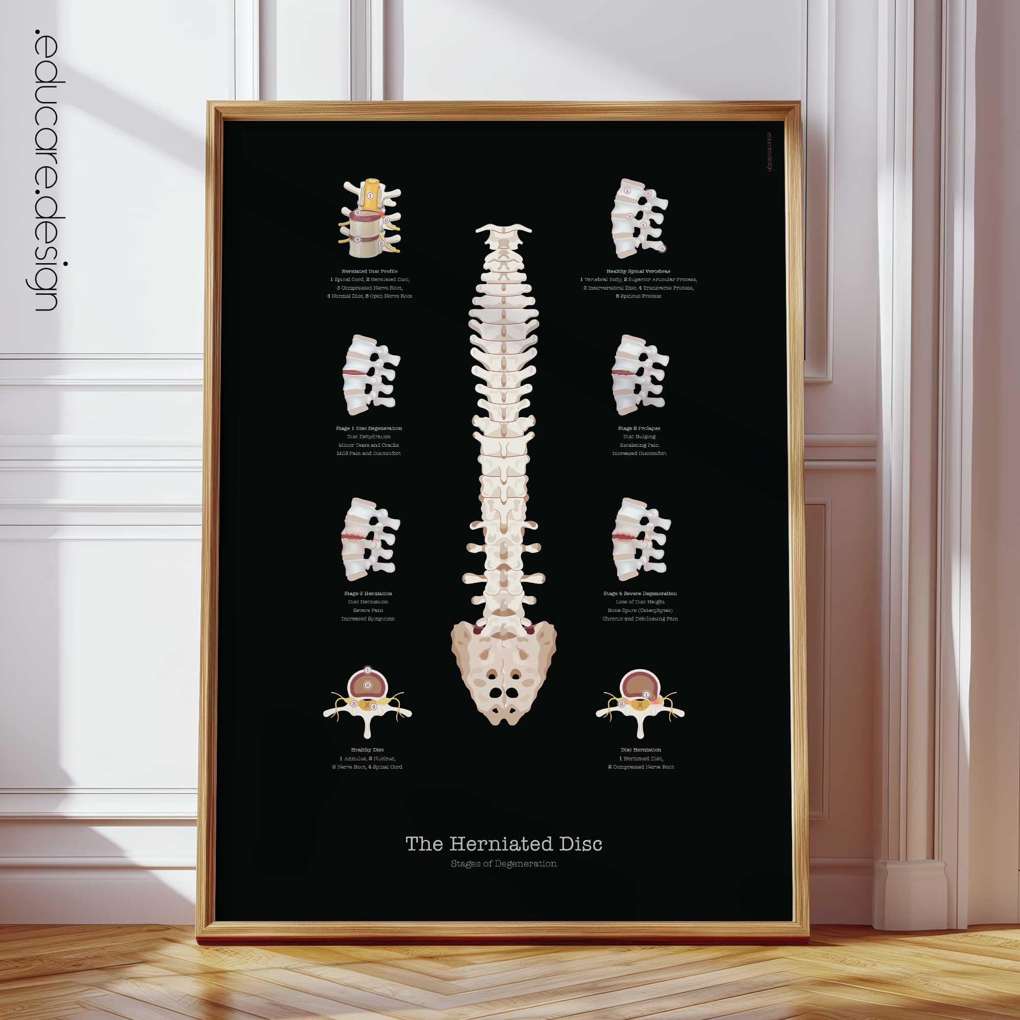 Herniated Disc Anatomy Chart, Black Edition
