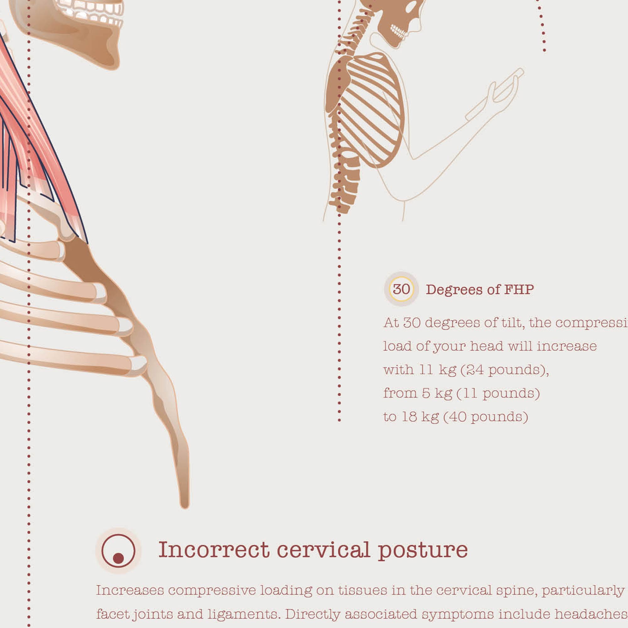Forward Head Posture chart