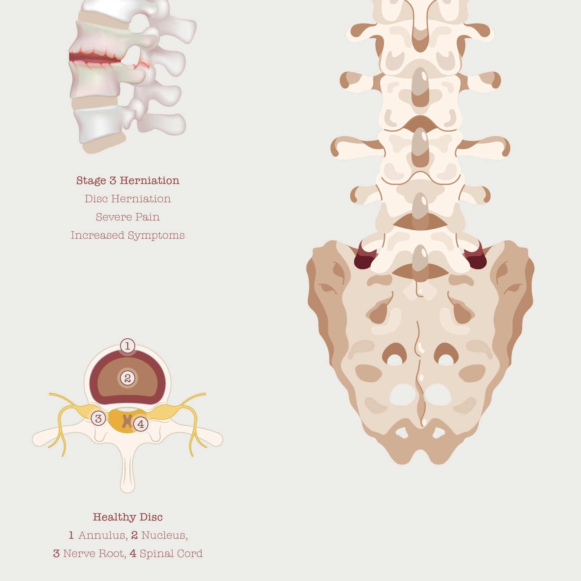 The Herniated Disc