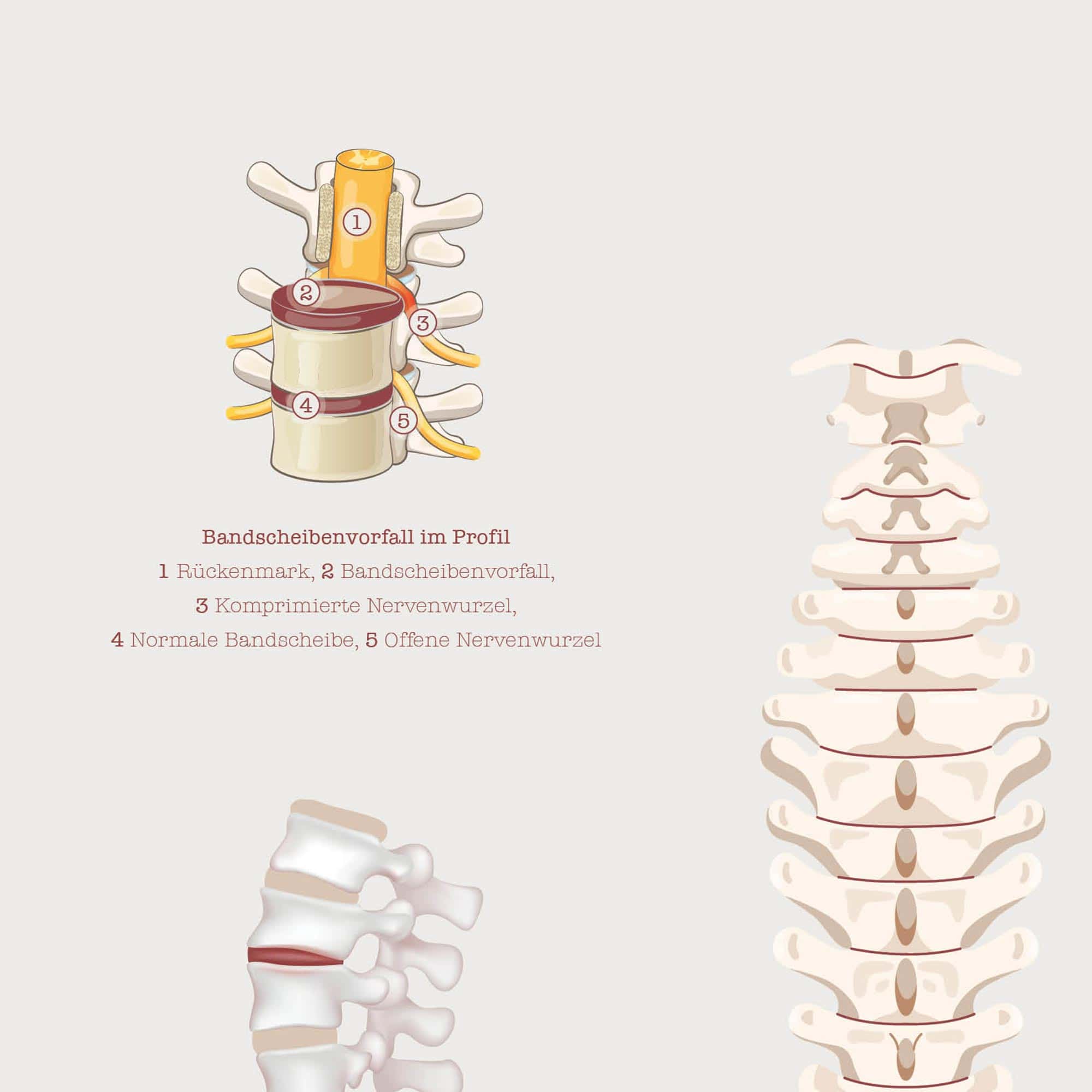 Der Bandscheibenvorfall