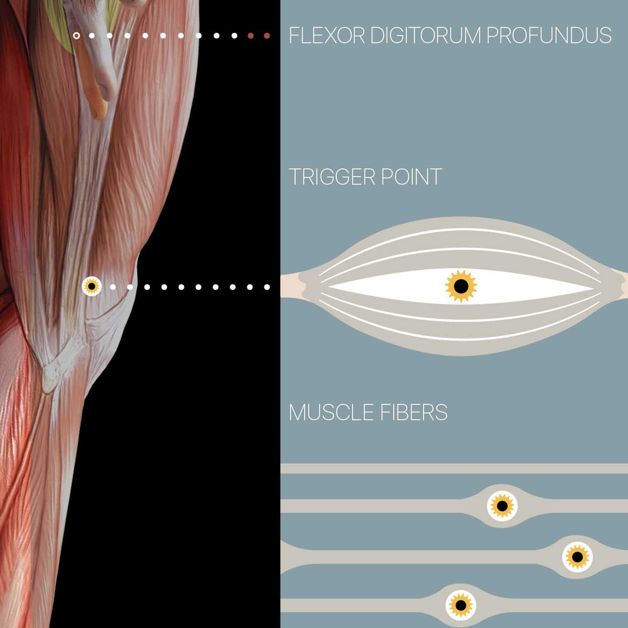 Myofascial Trigger Points Chart