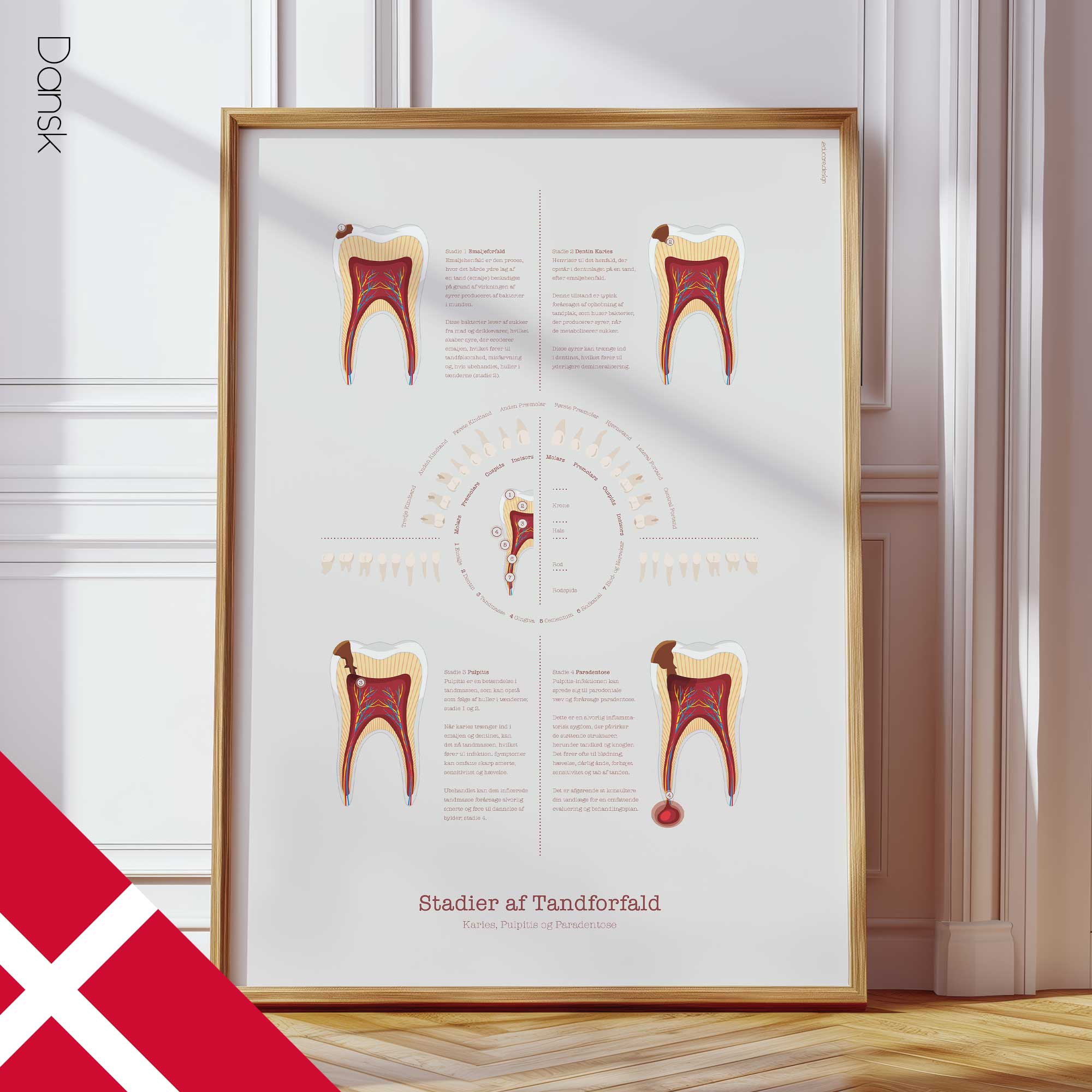 Stages of Tooth Decay