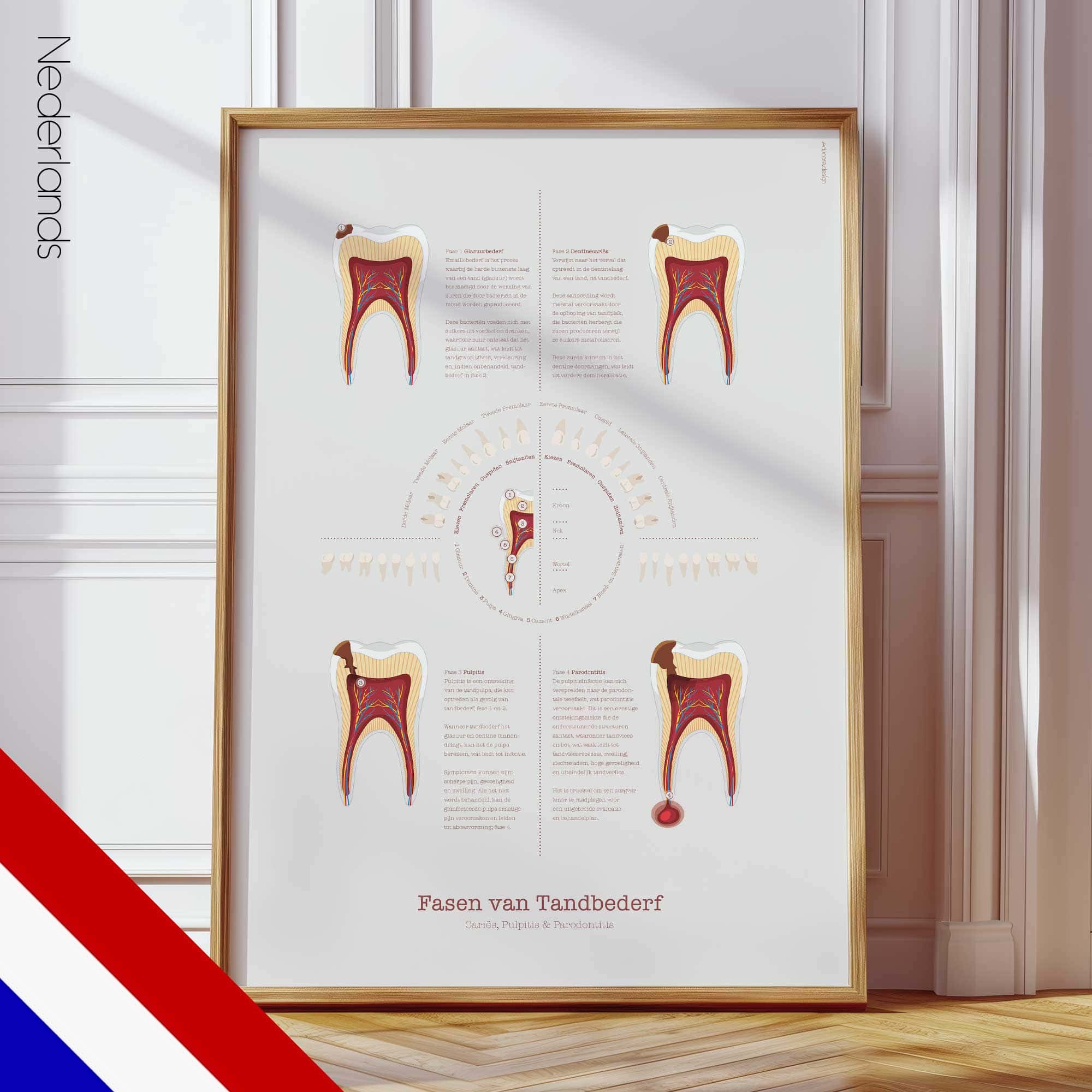 Stages of Tooth Decay