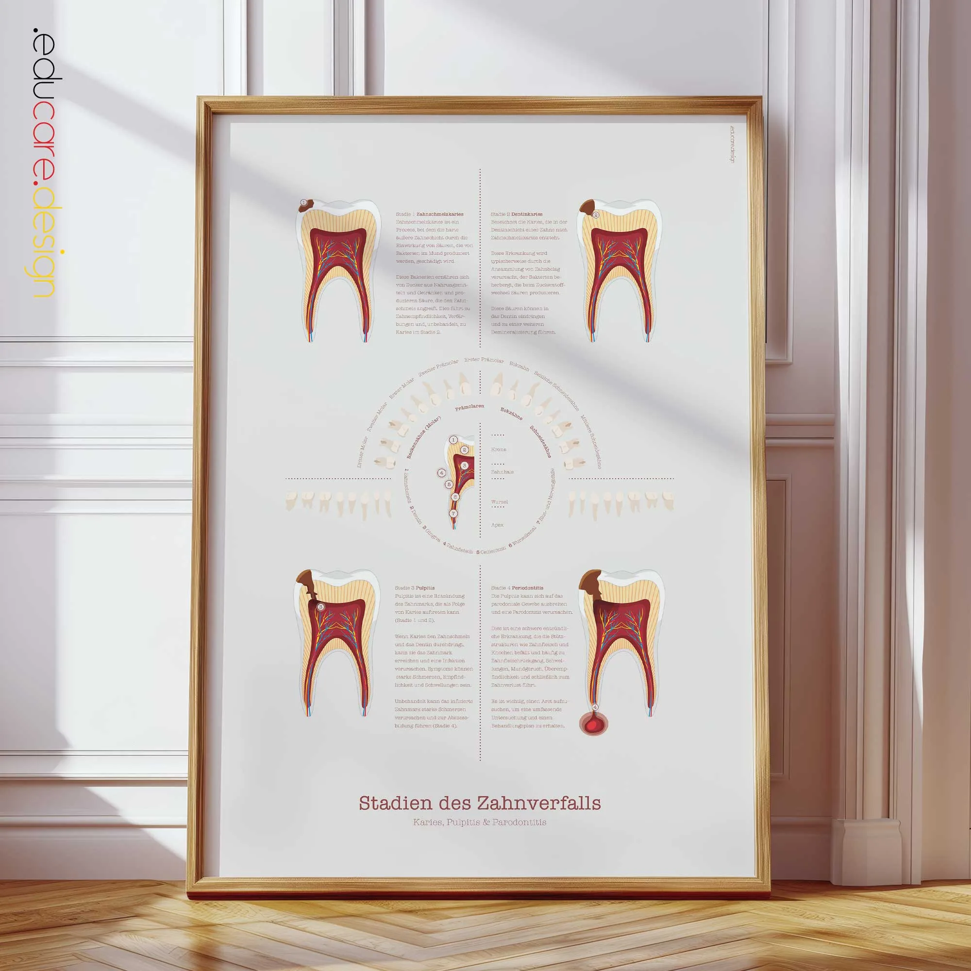 Stadien der Karies Anatomie-Chart für Praxen und Kliniken