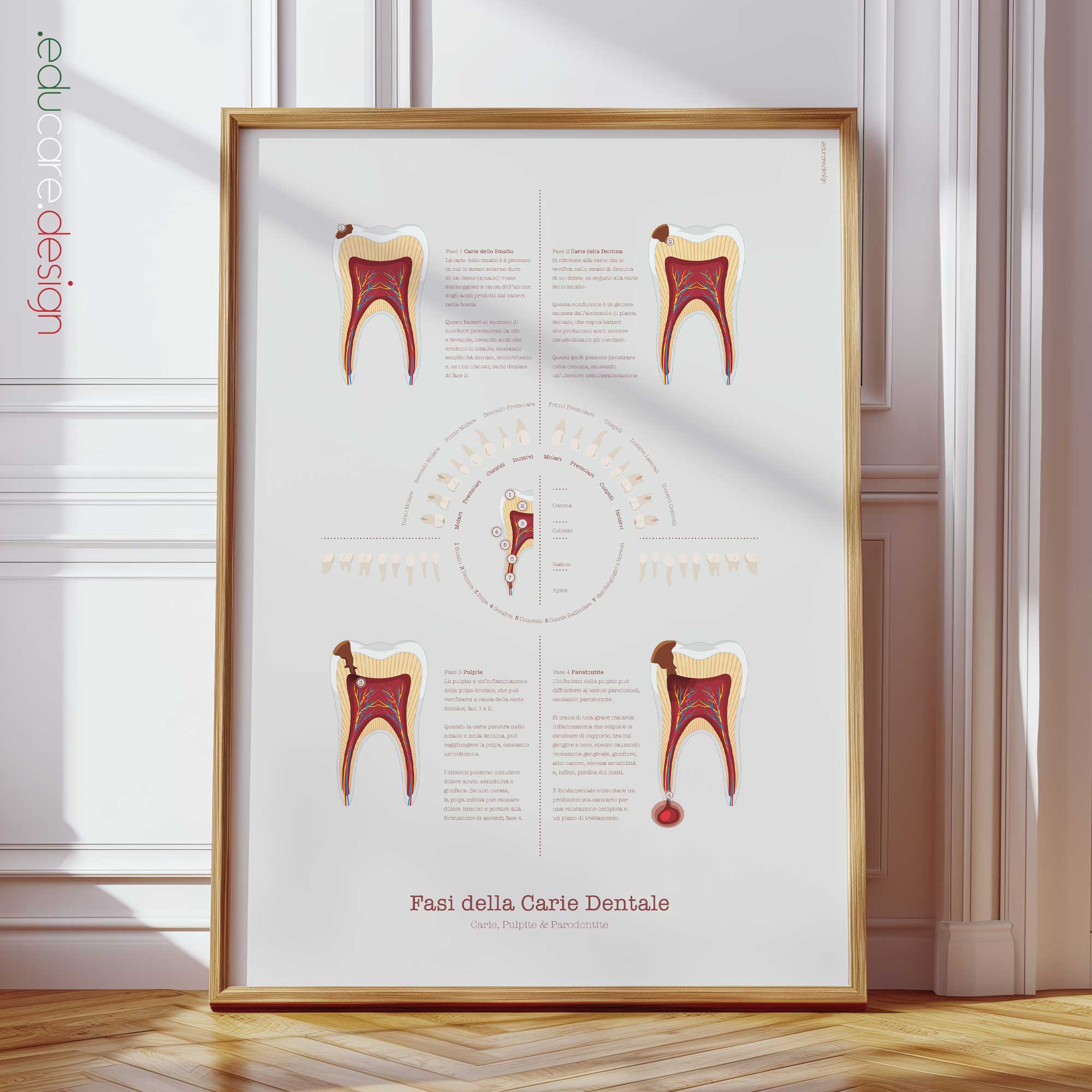 Fasi della Carie Dentale