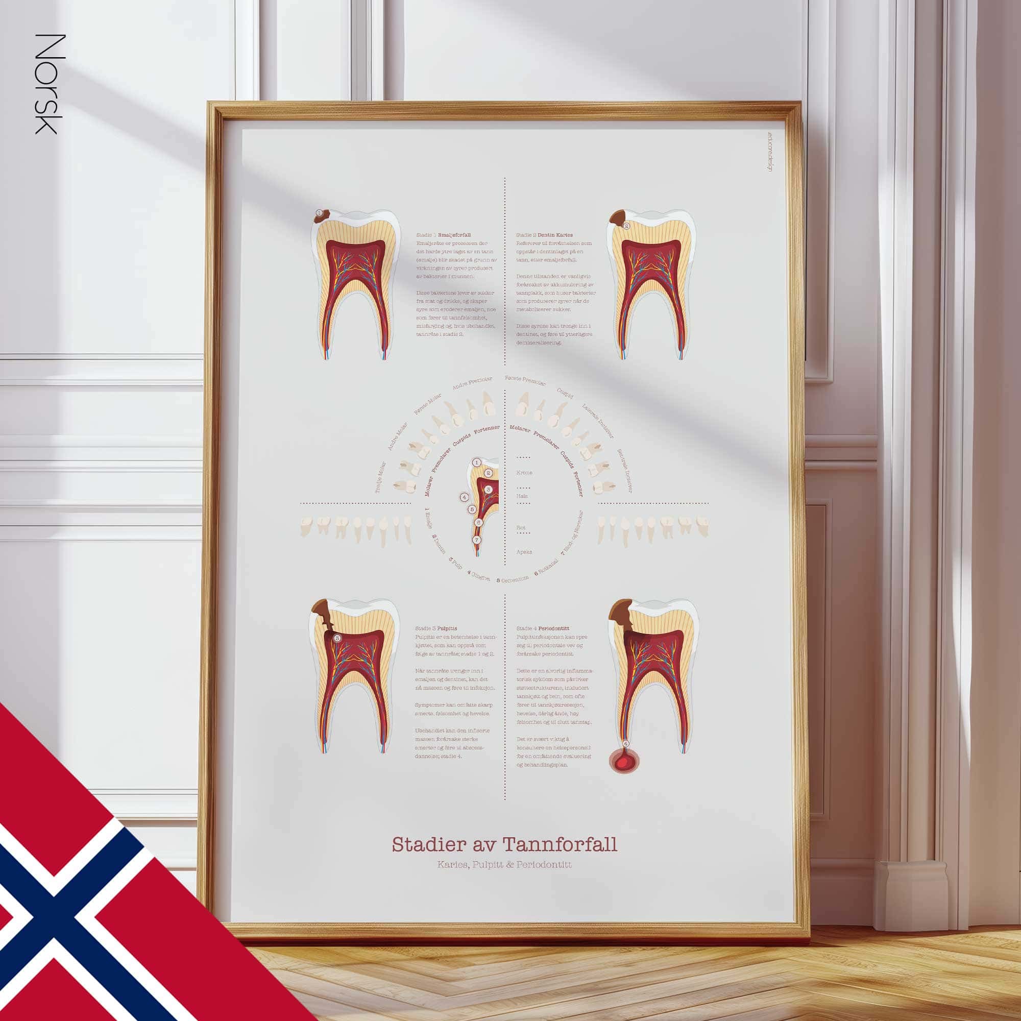 Stages of Tooth Decay