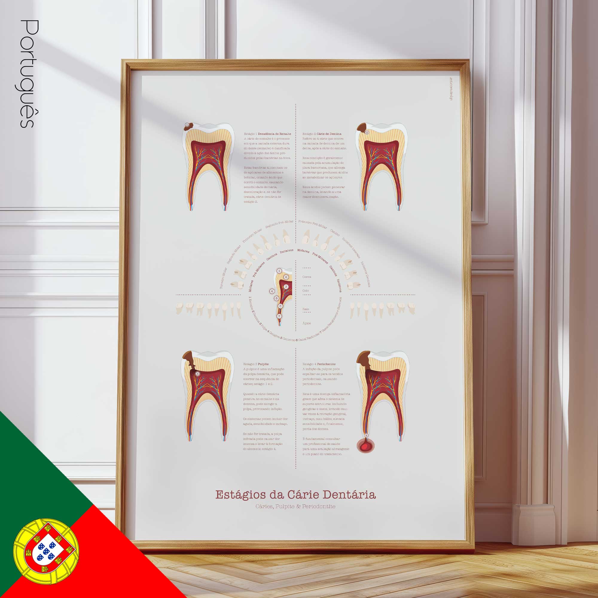 Stages of Tooth Decay