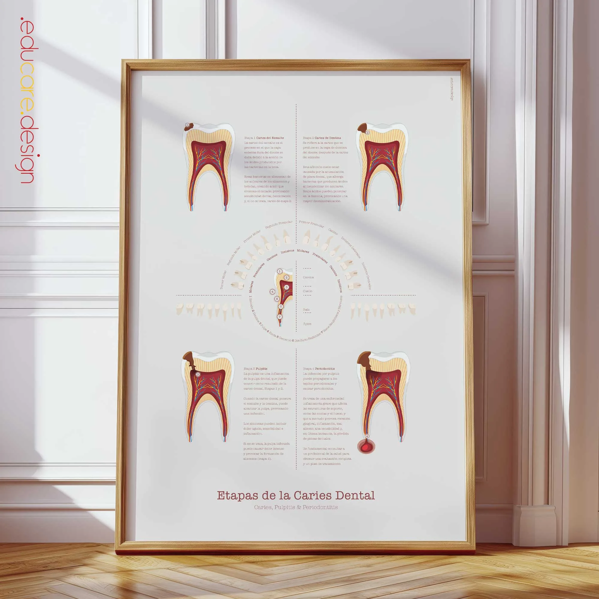 Etapas de la Caries Dental lámina anatómica para clínicas y consultas