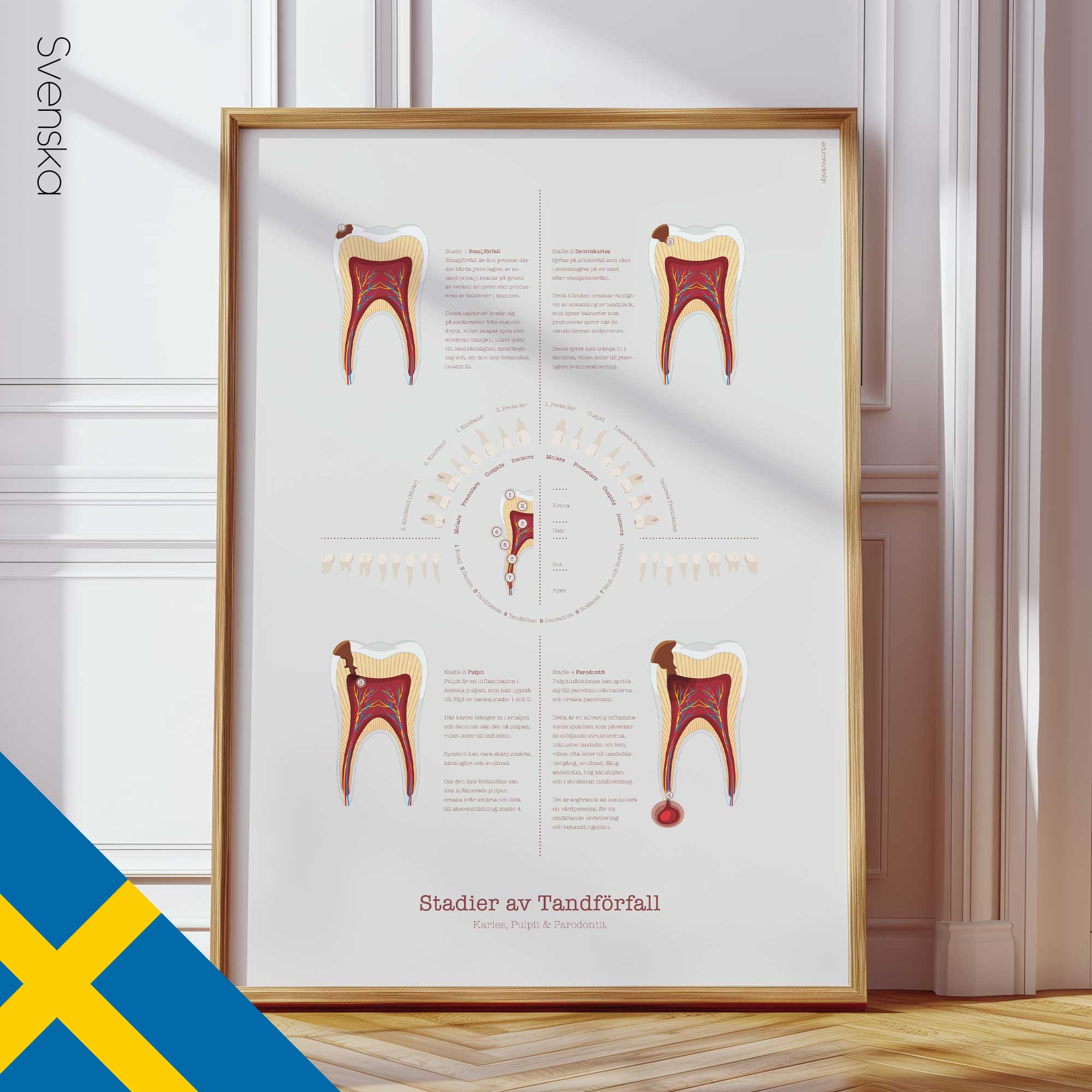 Stages of Tooth Decay