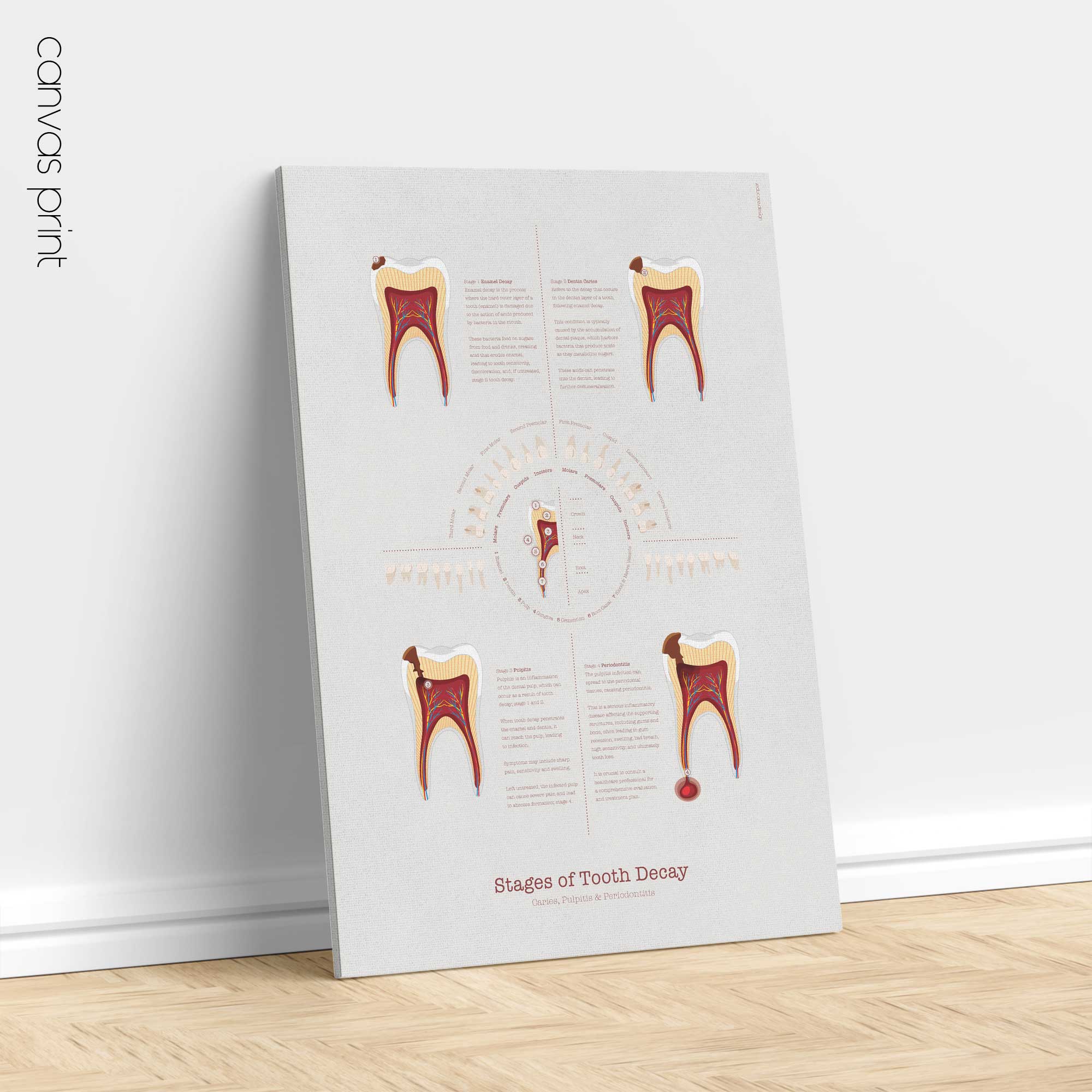 Stages of Tooth Decay
