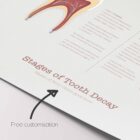 Stages of Tooth Decay