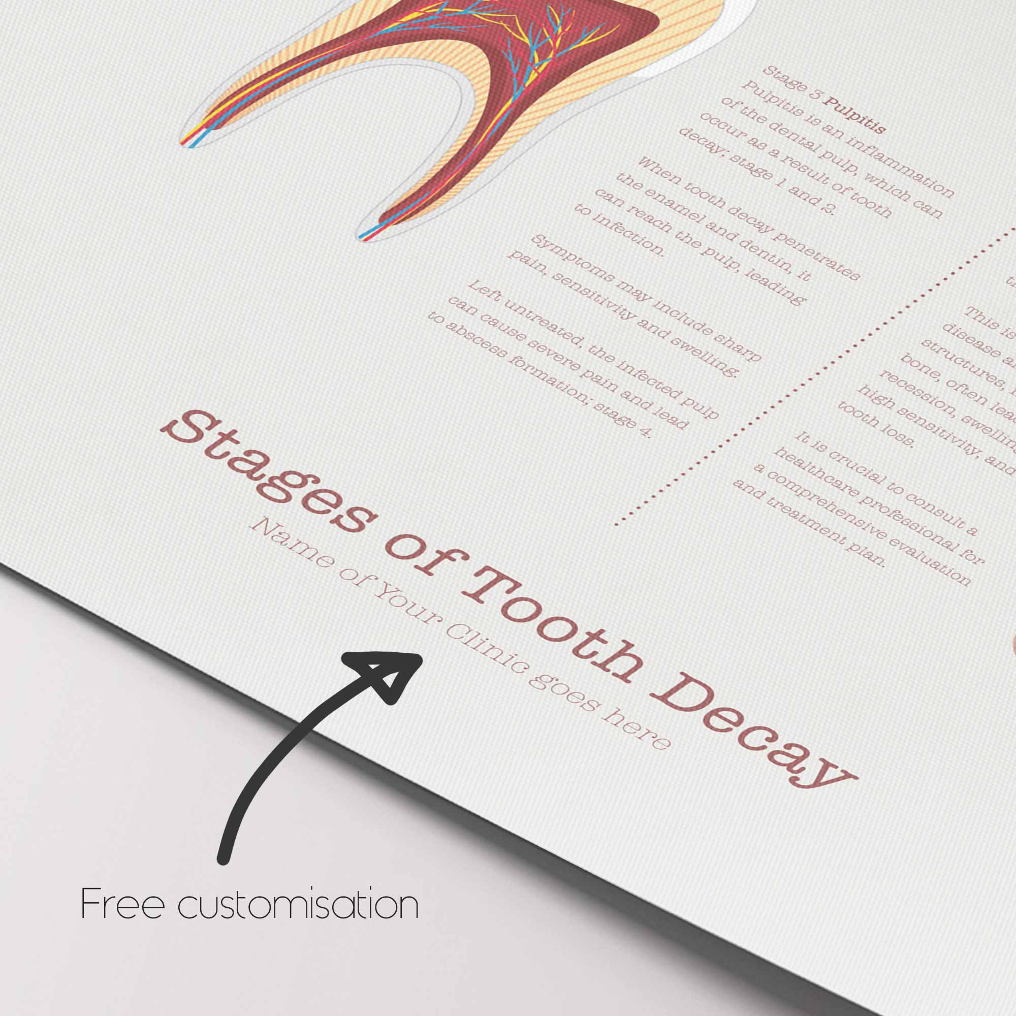 Stages of Tooth Decay