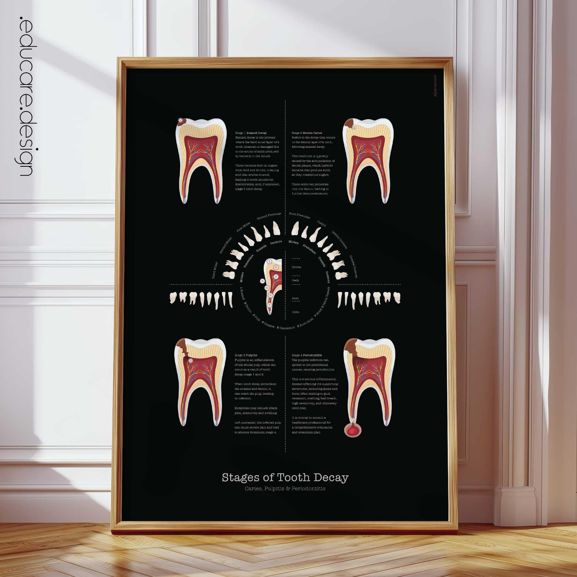 Stages of Tooth Decay Anatomy Chart, Black Edition