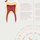 Stages of Tooth Decay