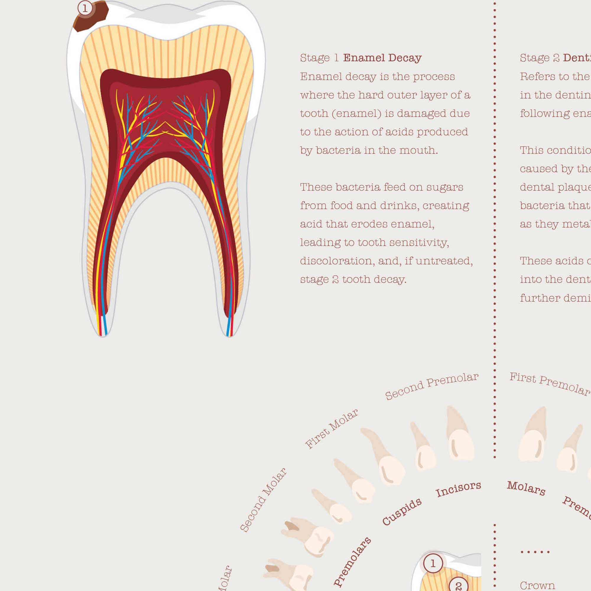 Stages of Tooth Decay
