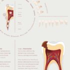 Stages of Tooth Decay