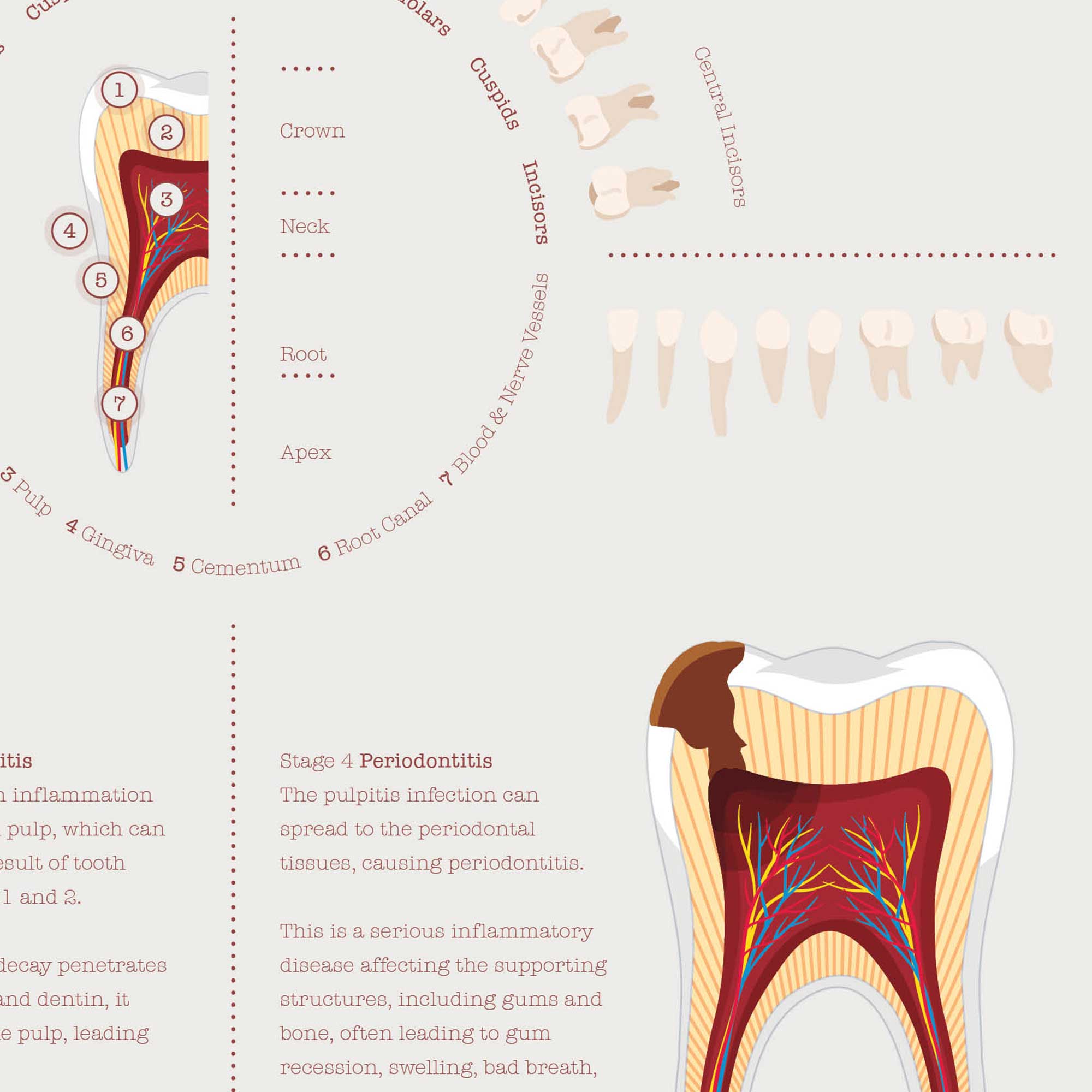Stages of Tooth Decay