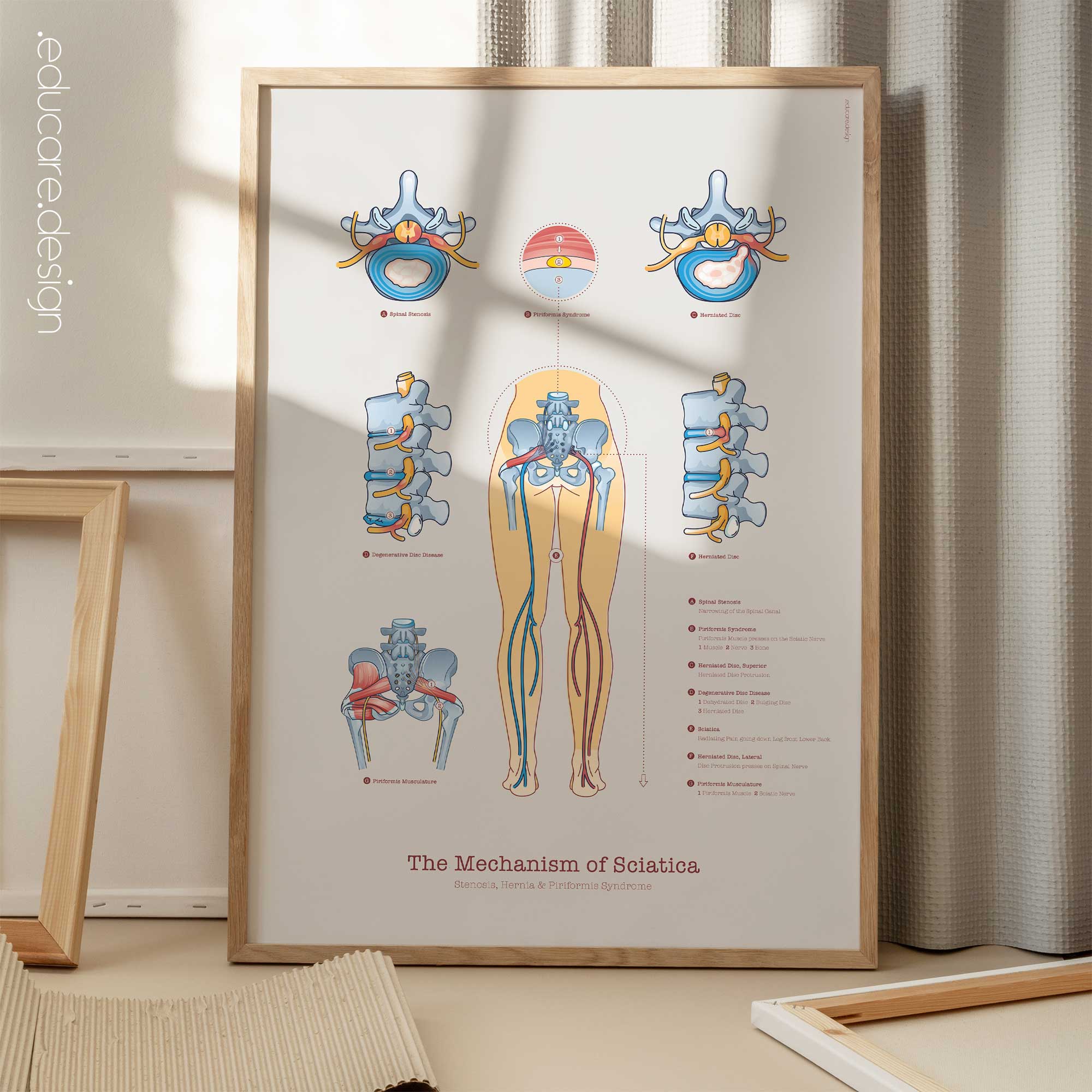 Sciatica with Stenosis, Hernia & Piriformis Syndrome
